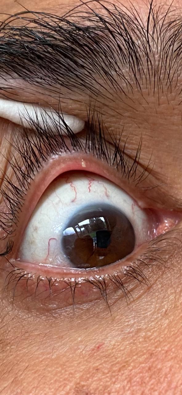 Is this stye, pimple or a capped gland? What could help? r/Dryeyes