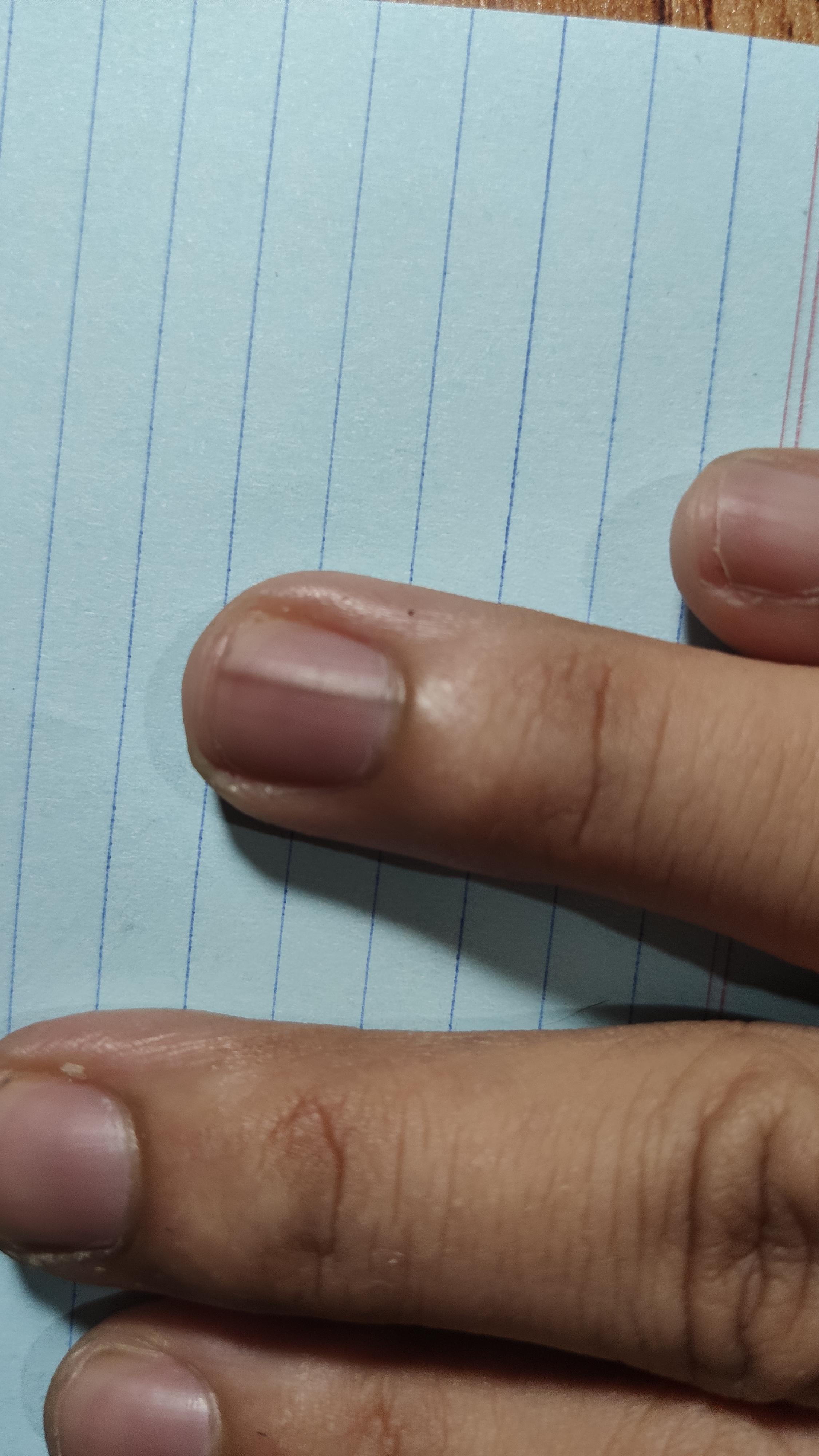 What is thie brown horizontal line on my fingernail? Had this for about