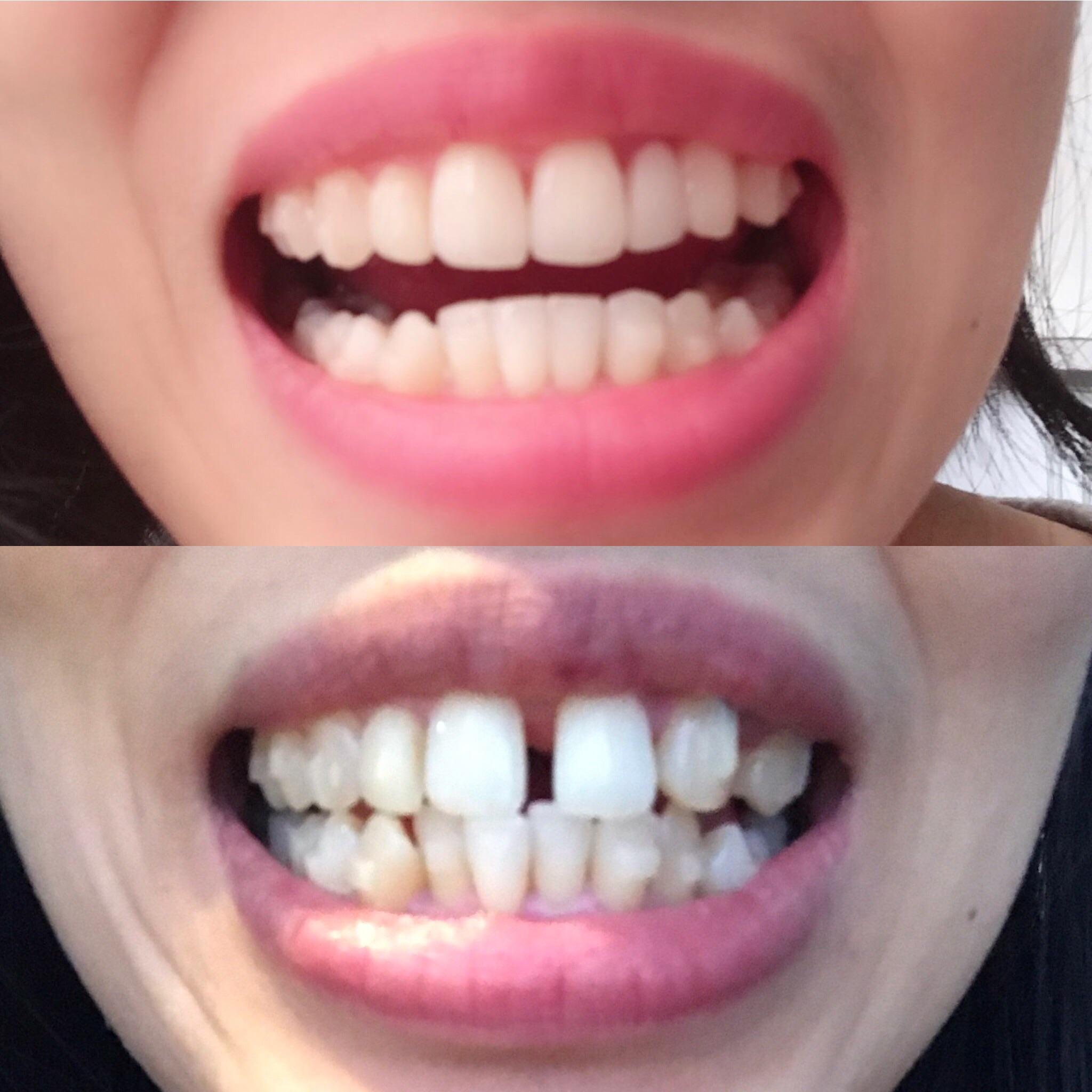 After 57 trays + an incisor flipper r/Invisalign