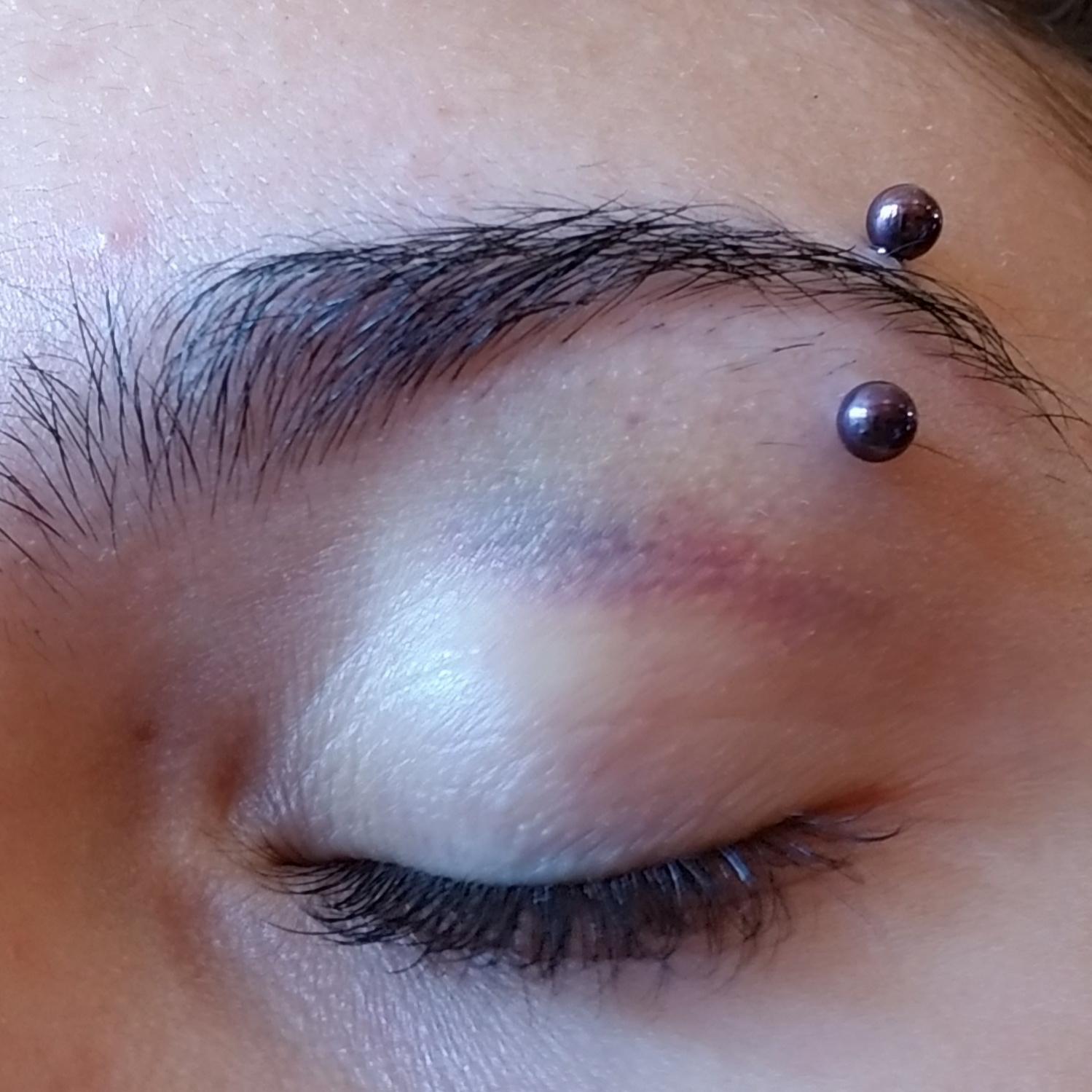 is it normal for an eyebrow piercing to be this bruised? i got it a