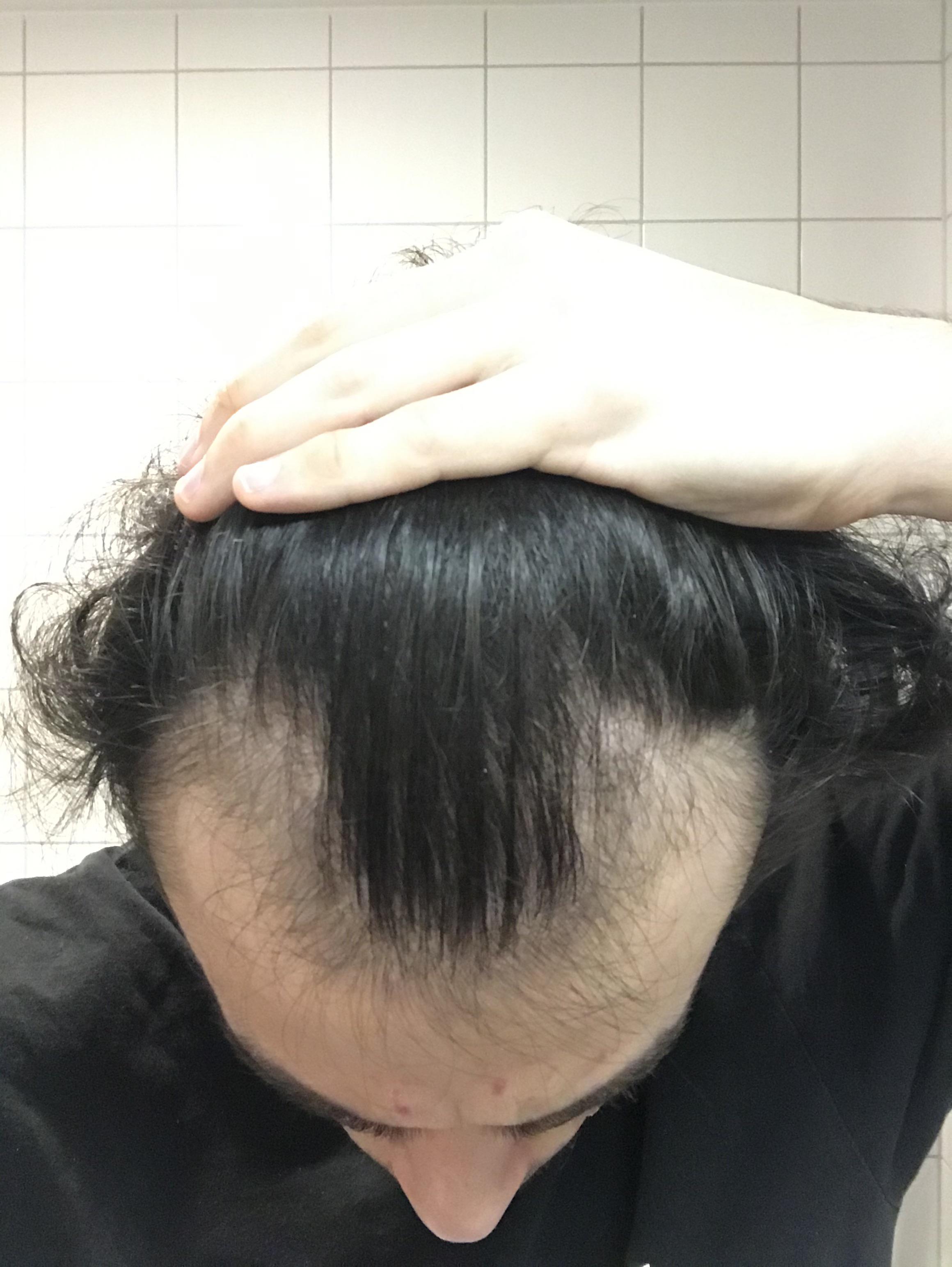 20M Minoxidil 1x everyday, 1 month. I’m losing crazy amounts of hair