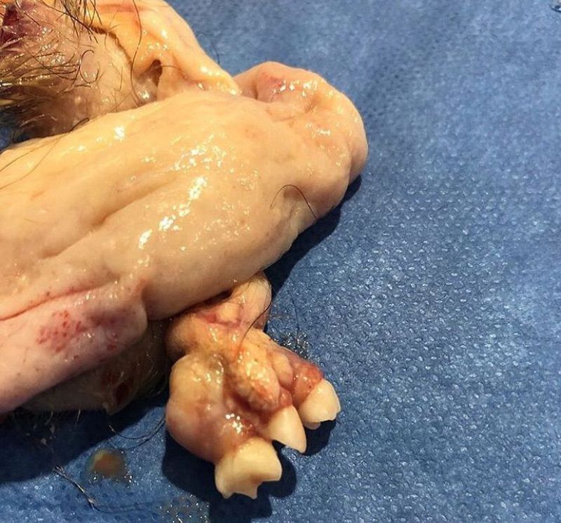 Cysts With Teeth And Hair Photos TeethWalls