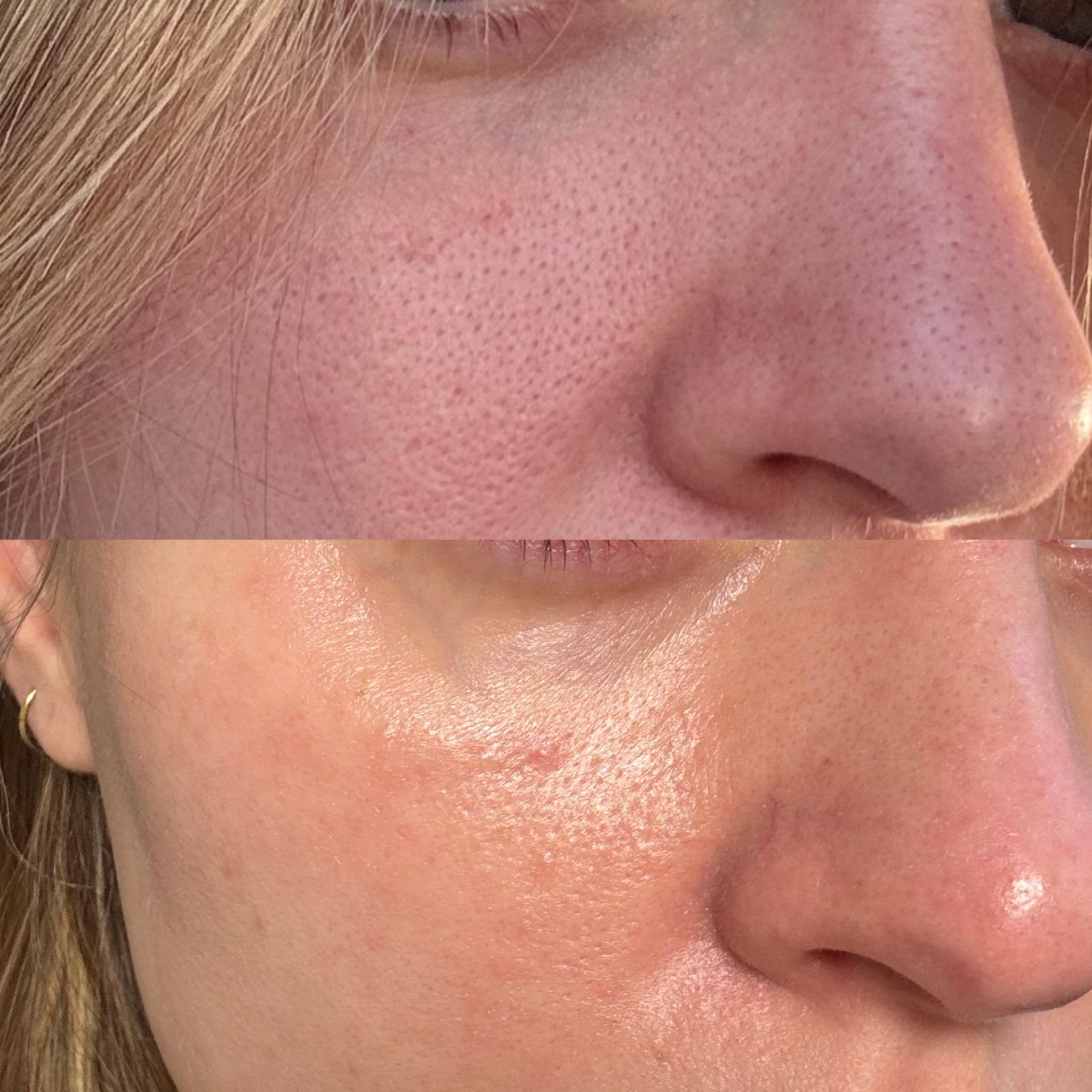 Found a miracle for my enlarged pores/sebaceous filaments r