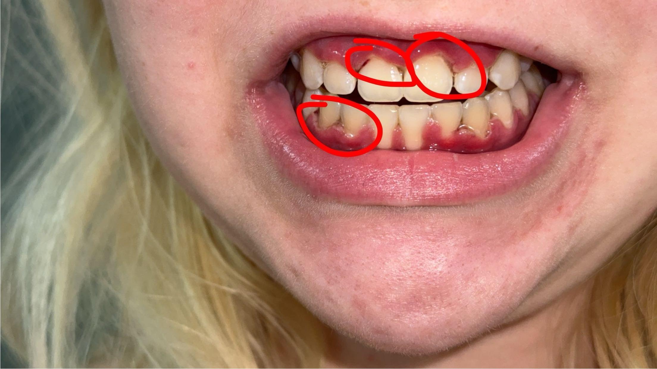 white lines on gum line? r/askdentists