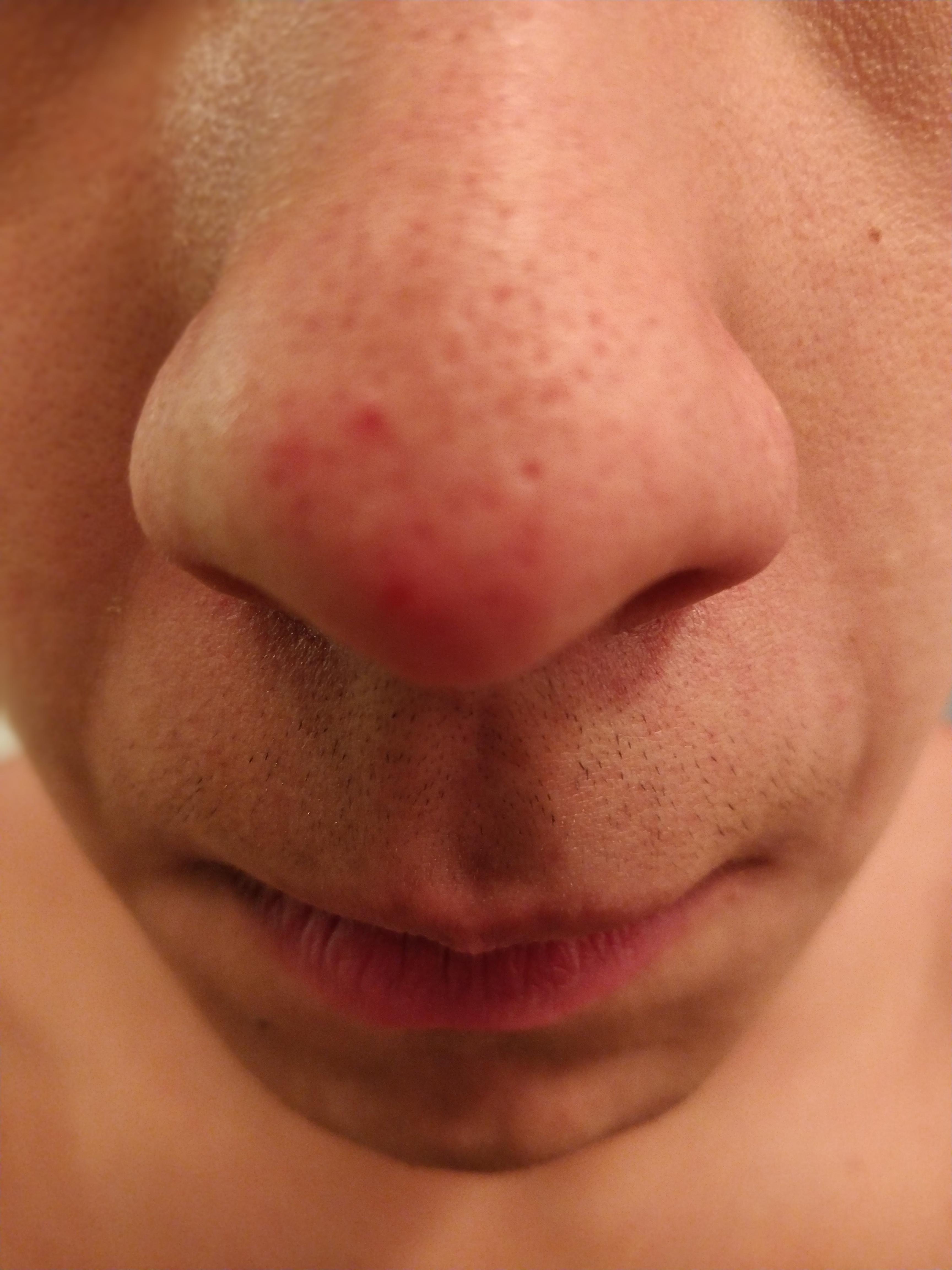 Big Blackheads The Secret To Achieving Flawless Skin Truth or Fiction