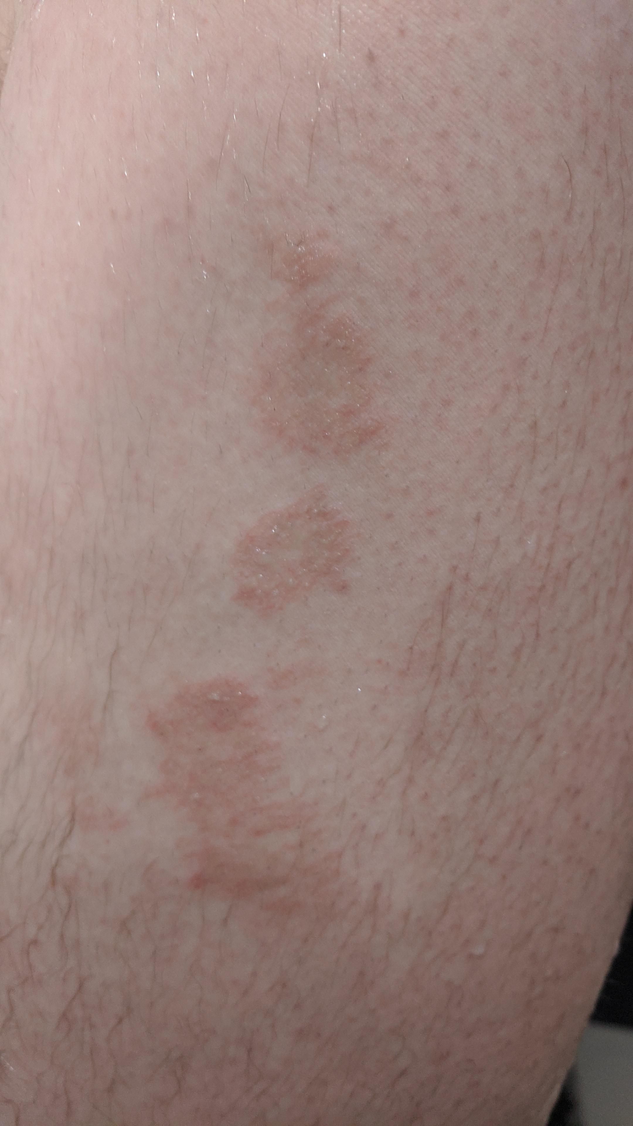 Rash on upper thigh, Help? r/DiagnoseMe