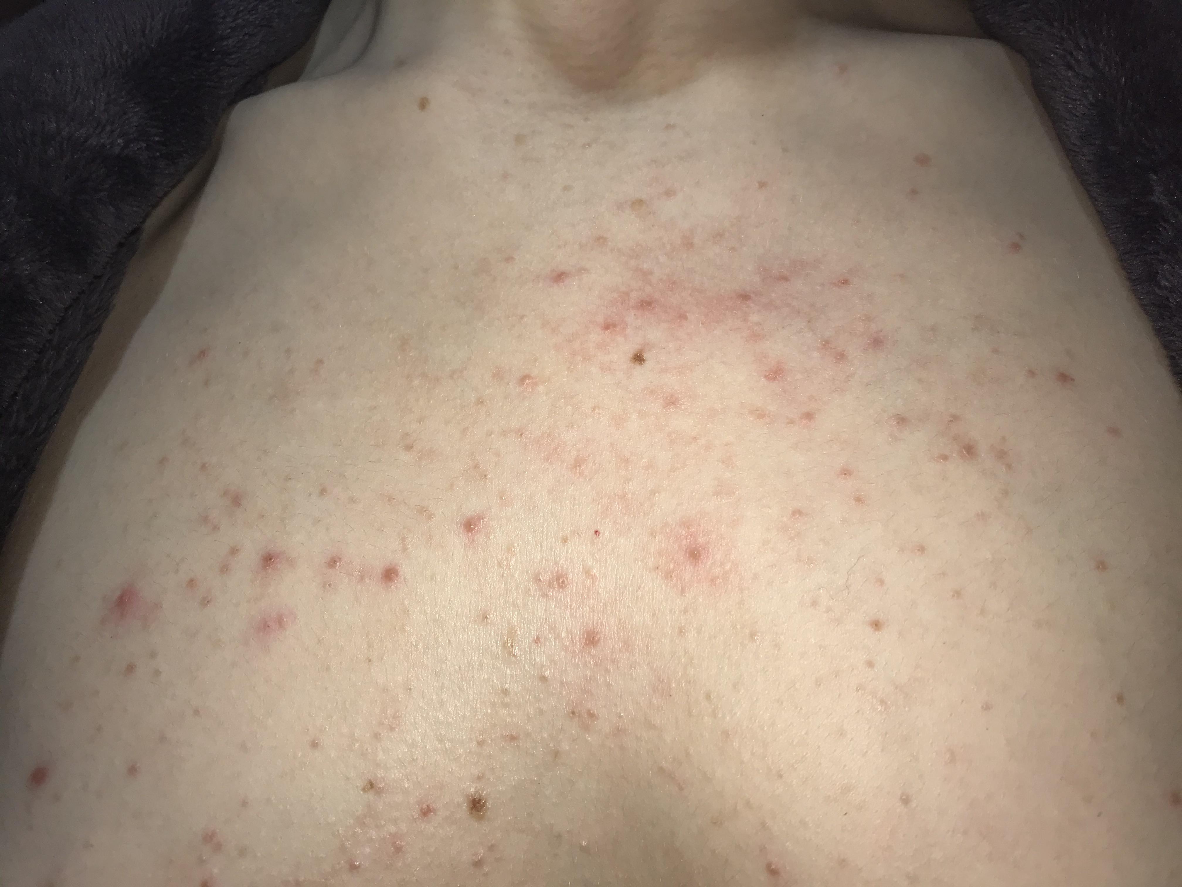 What is this? Acne, Folliculitis, heat rash or allergy? Nothing worked