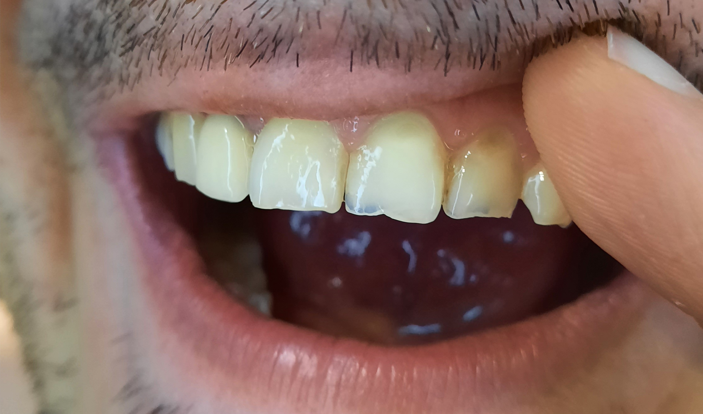 I'm about 12 hours from getting my wisdom teeth out, and I am