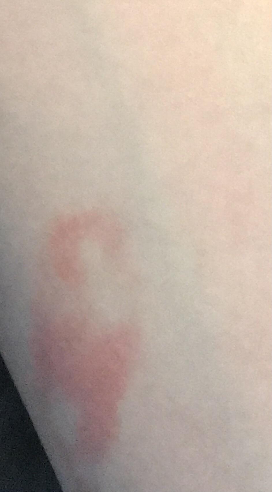 I keep getting these red marks on my skin the day after a workout. Can