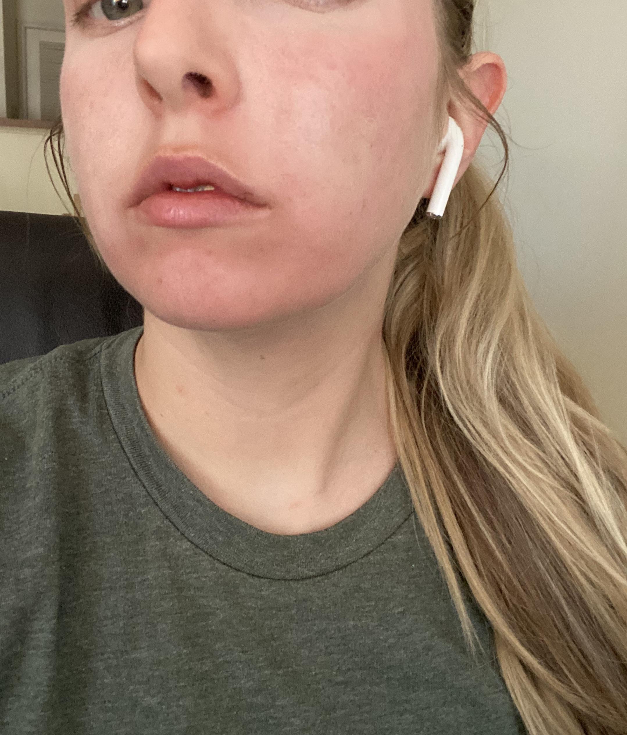 Retinol burn? r/acne