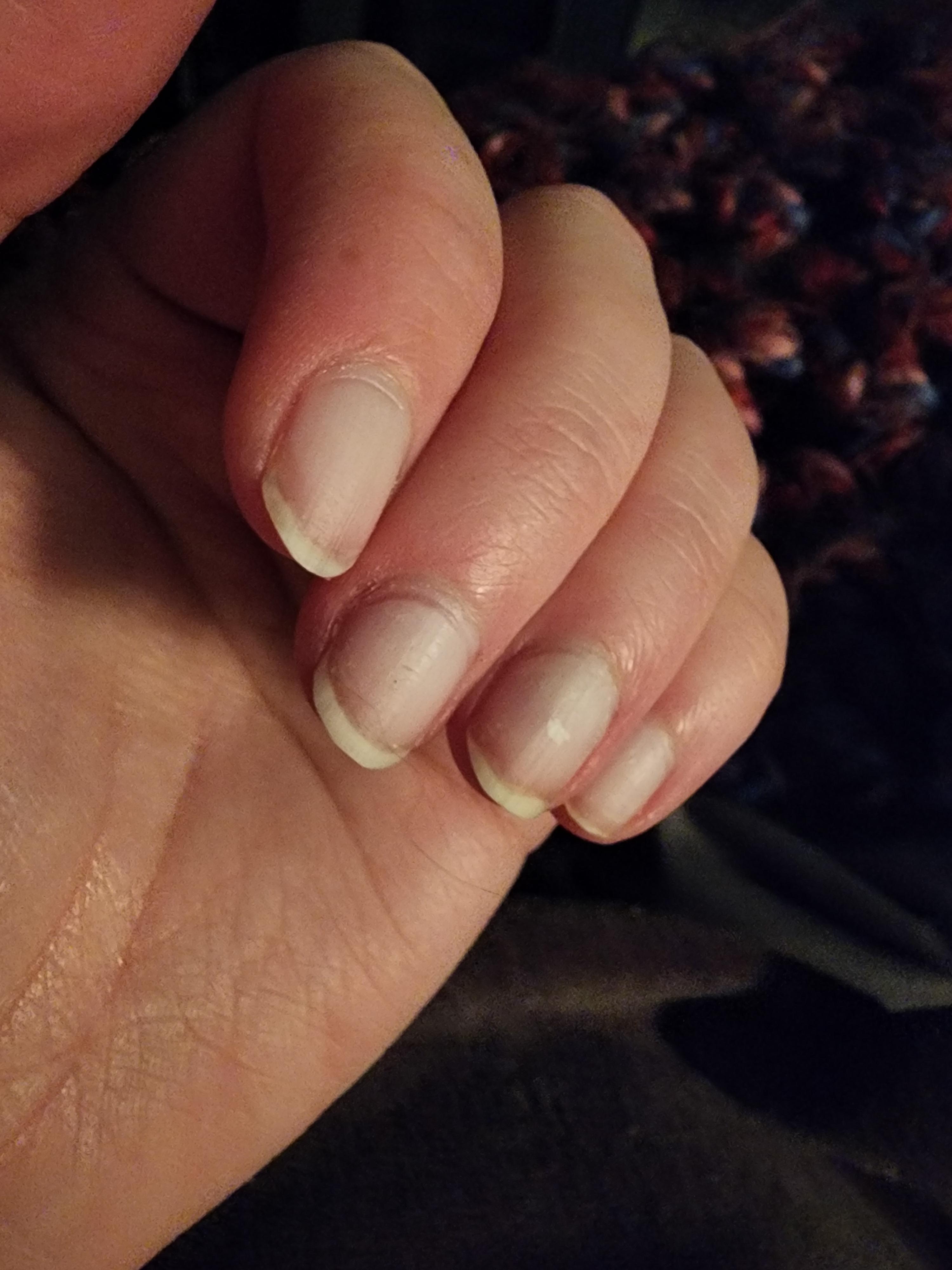 Gouge in nail after acrylics? Dark line on middle nail is a gouge, does