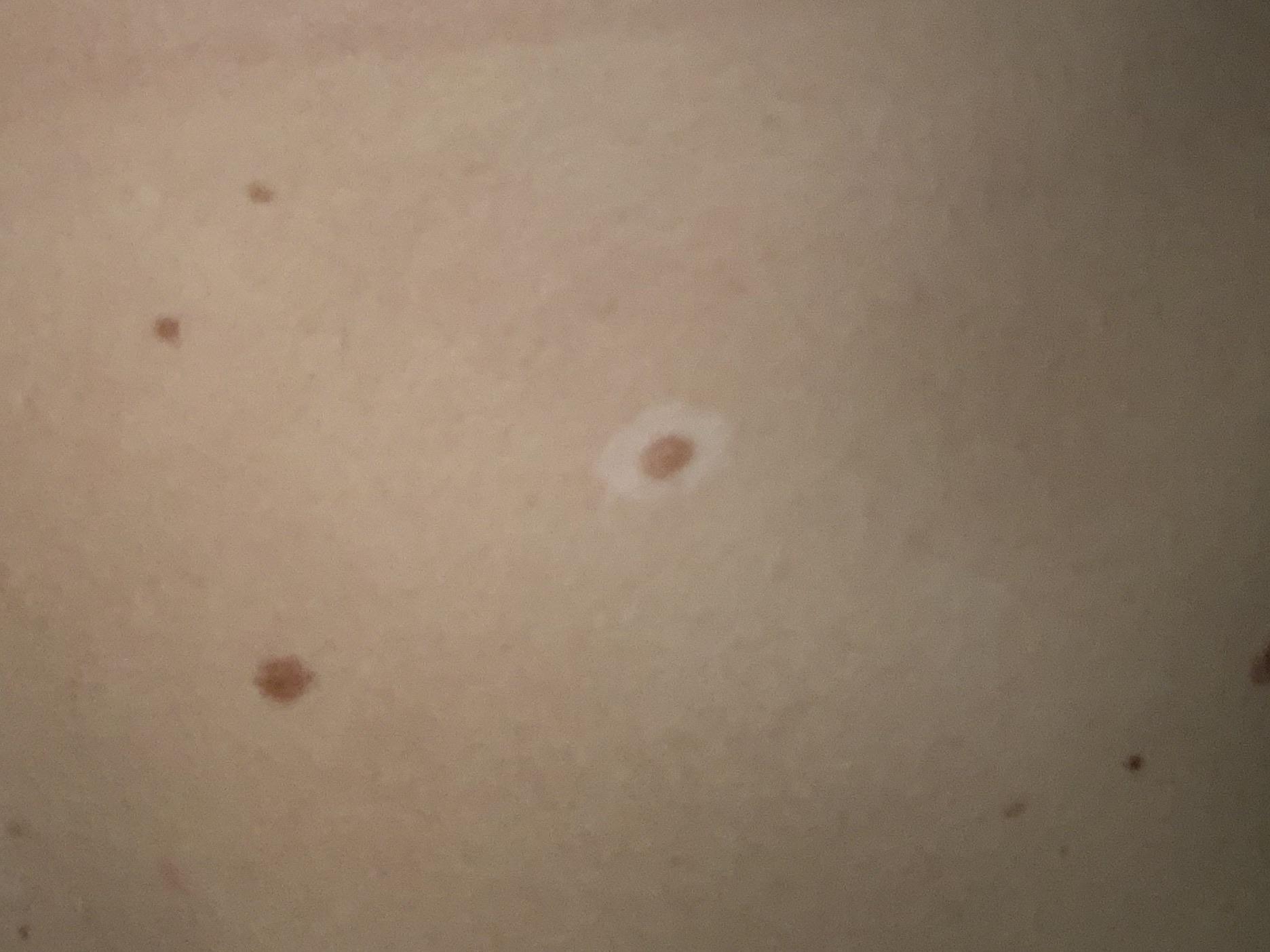 White circle around mole. This just appeared within the last few weeks