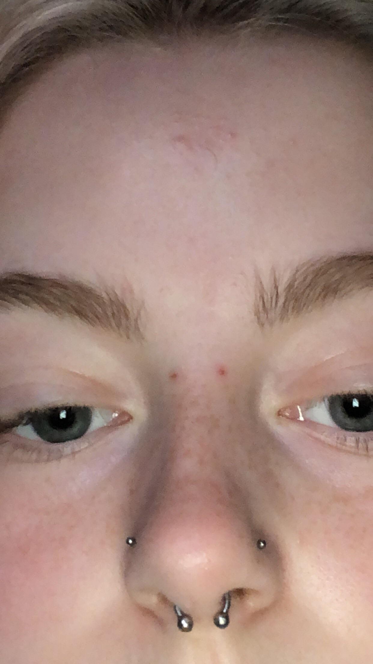 recently took my bridge out due to it rejecting, is there anything i