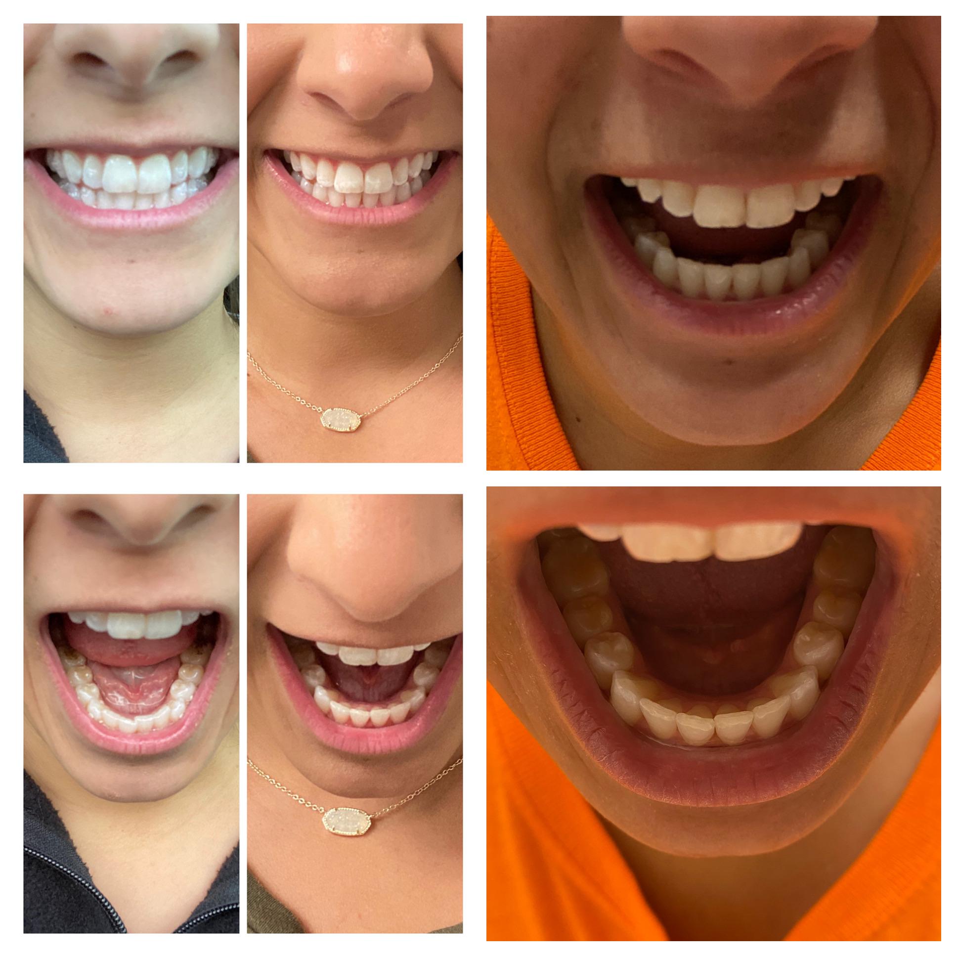 Looking mainly at lower teeth Day 1 —> end of treatment —>and then orange shirt is after