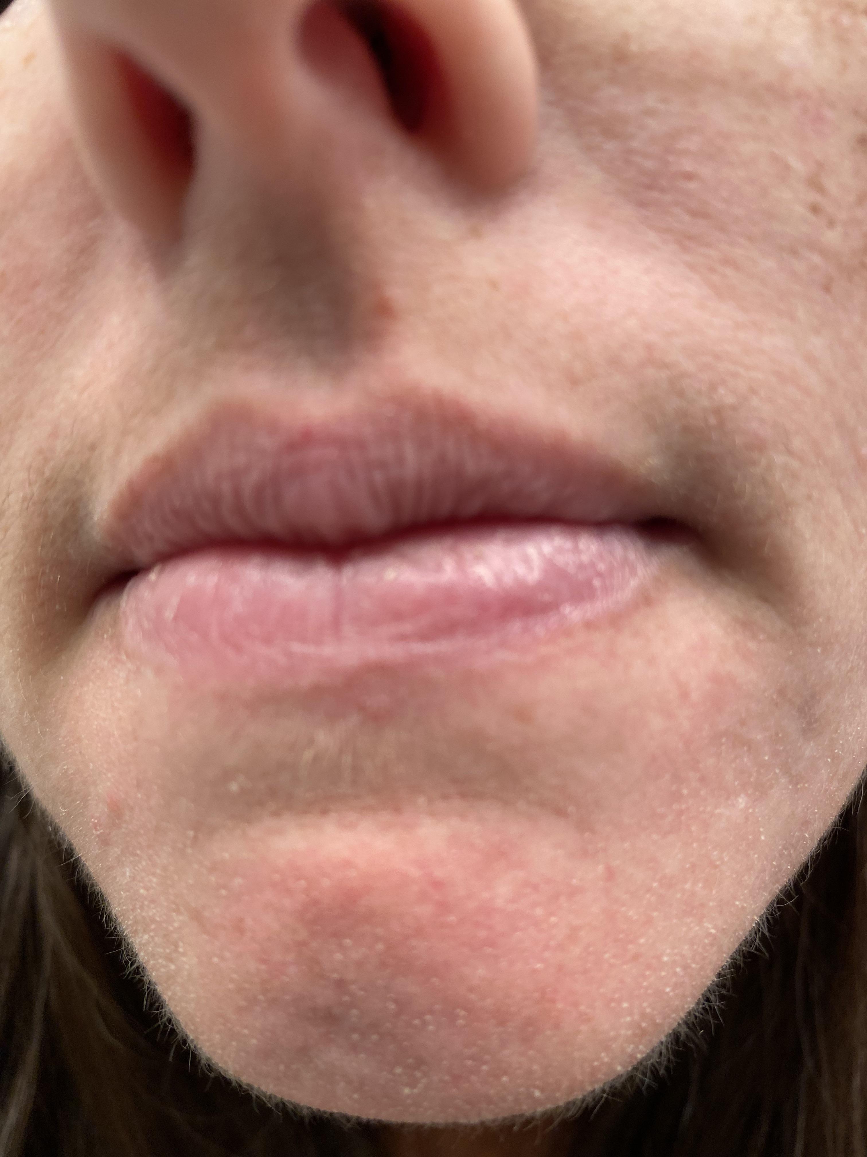 Chin issue. I exfoliate (mechanical or chemical), moisturize, and these