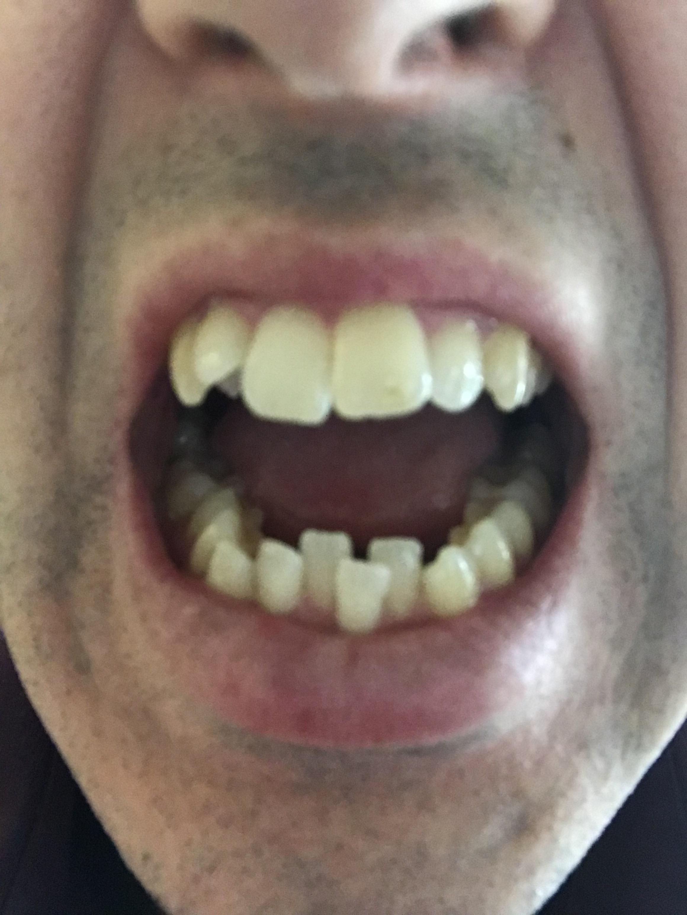Can Invisalign fix this overcrowding? r/Invisalign
