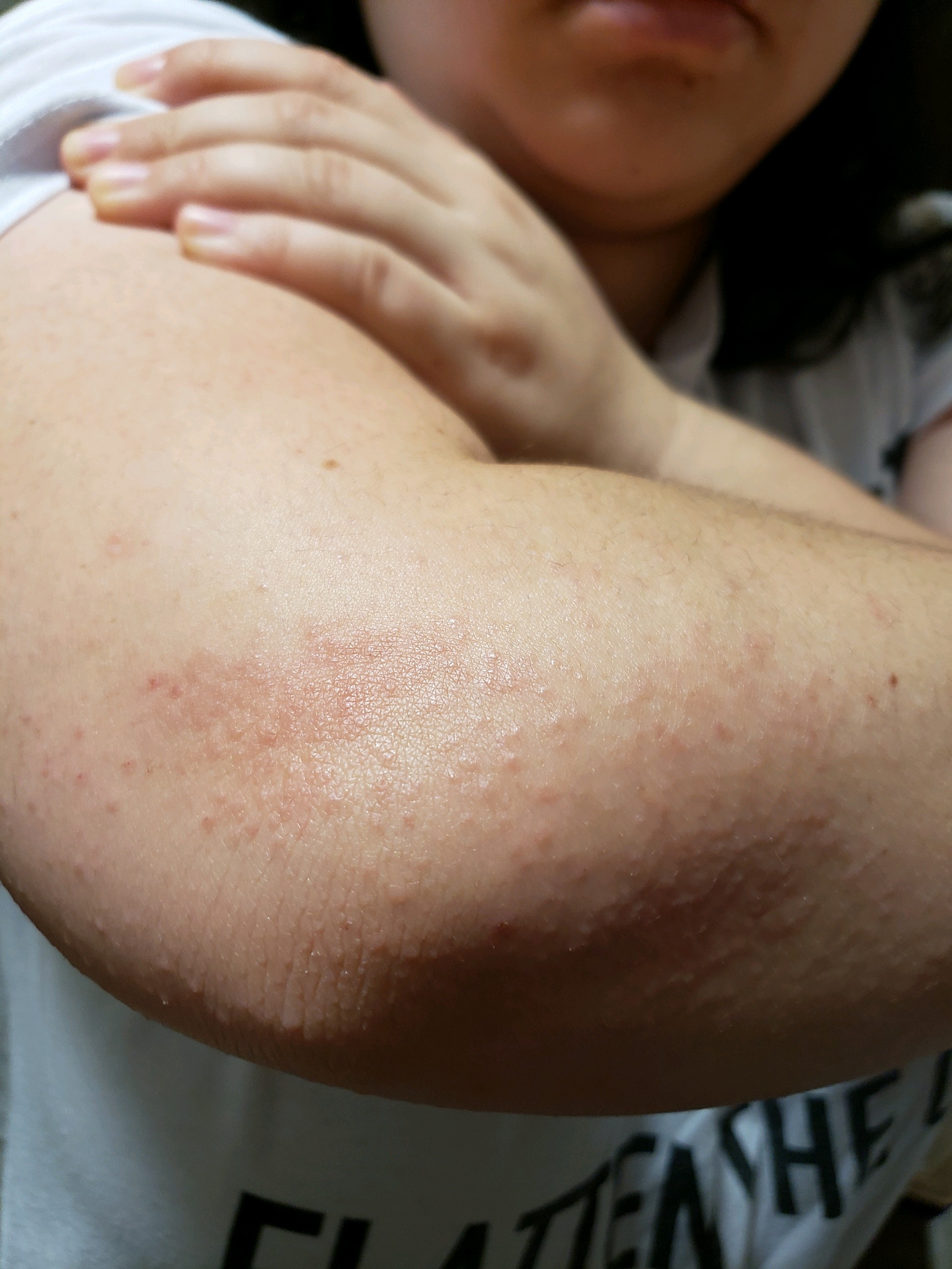 Was told this was scabies by my dermatologist without a skin scrape. Is