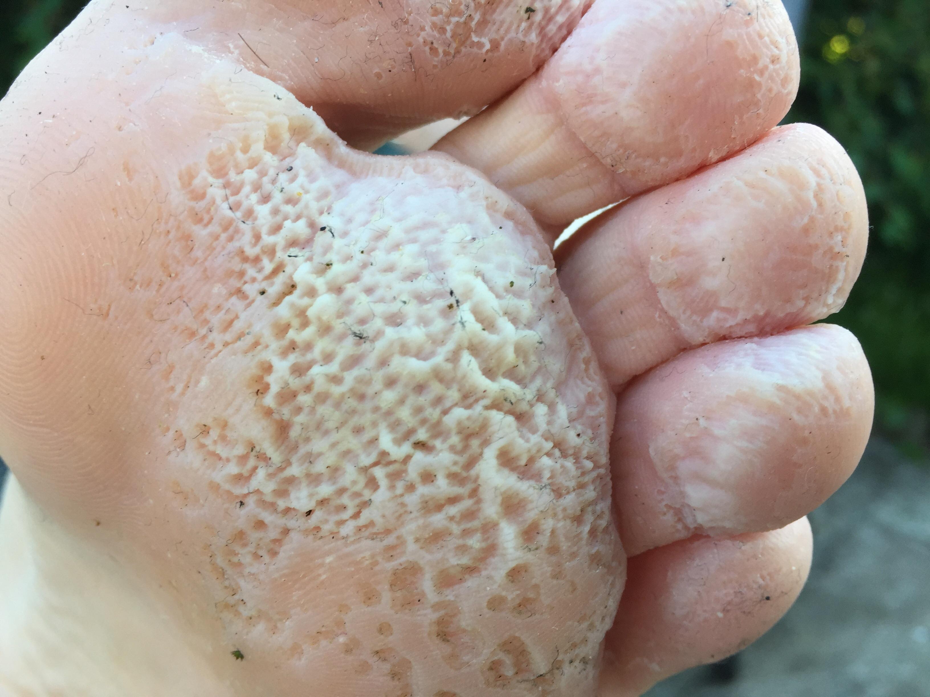 Max's foot r/trypophobia