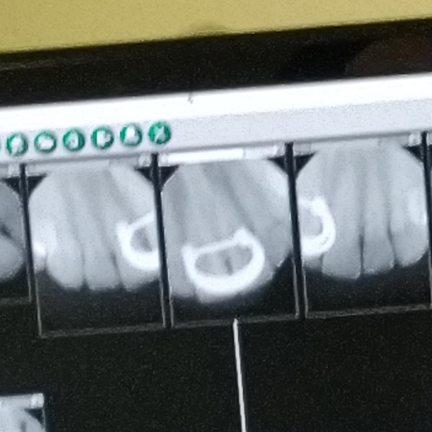 You can see my nose ring in my dental xray. r/mildlyinteresting
