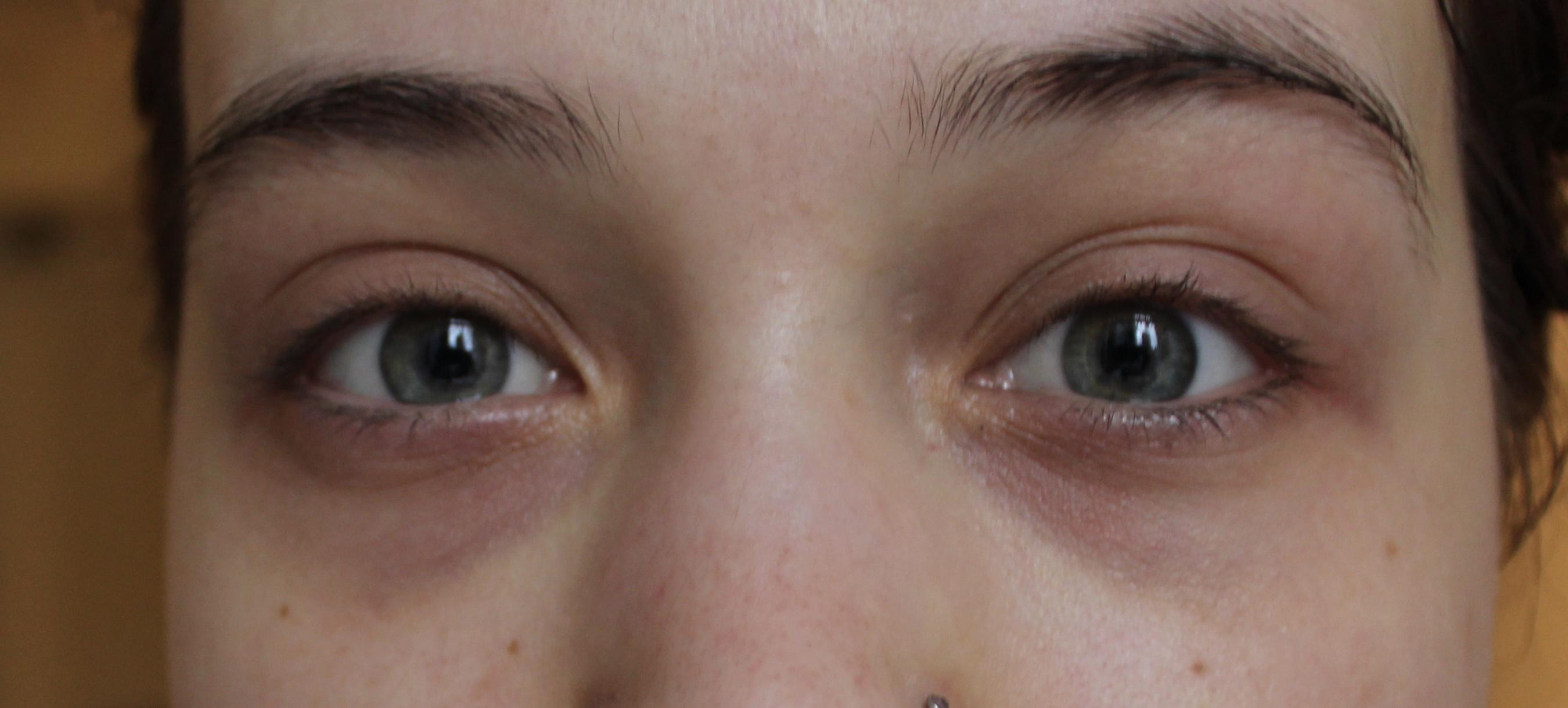 [B&A] Got tired of resembling like I do meth for fun so I got fillers