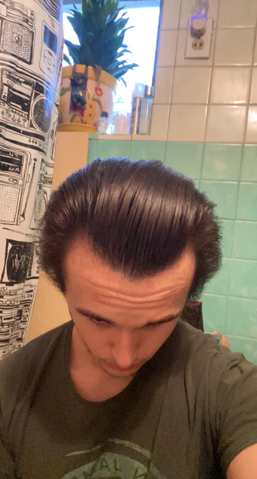 One week on derma rollers 0.25 every other day, Minoxidil foam 5, and