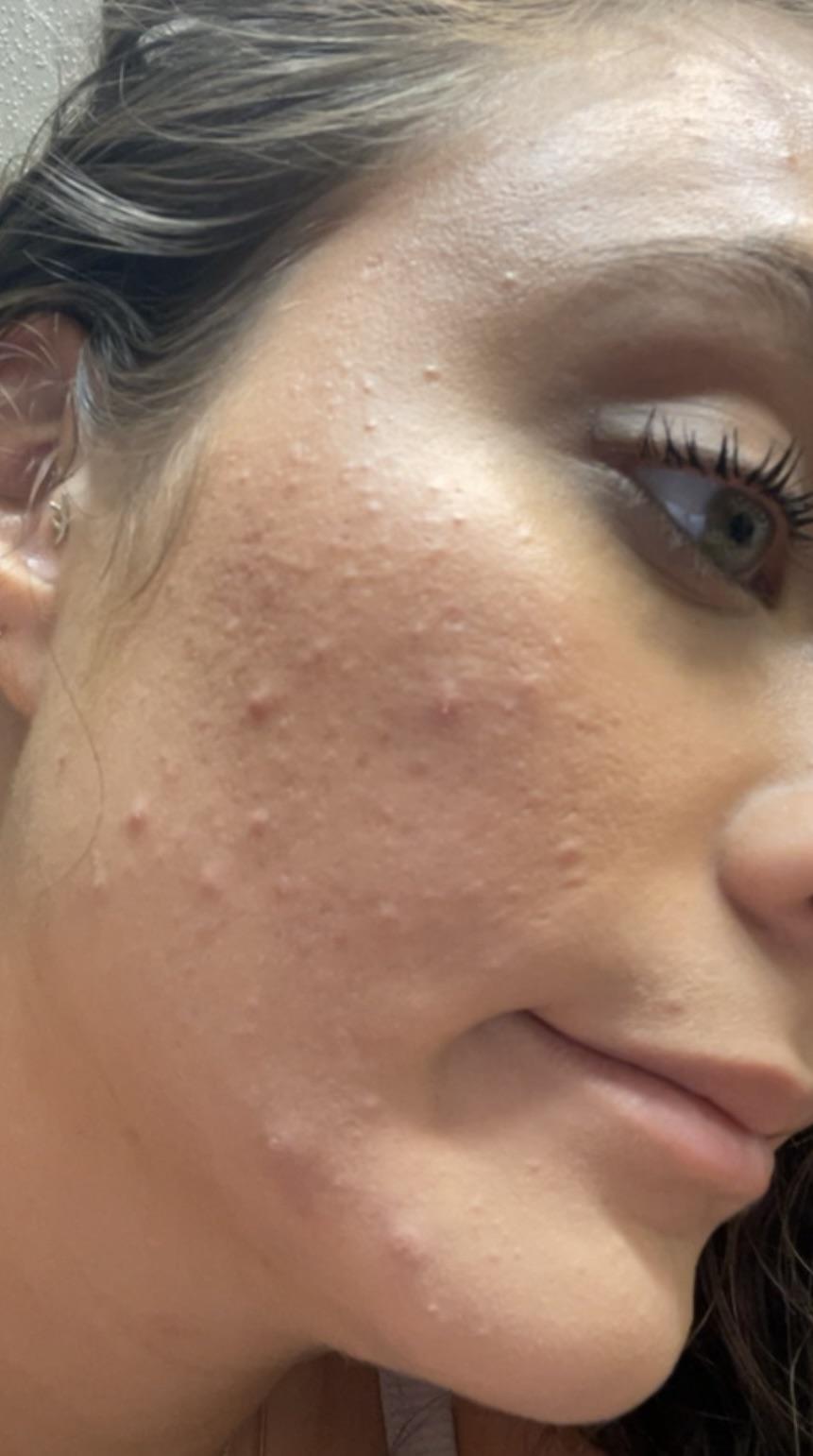 Bleaching my Hair? Accutane