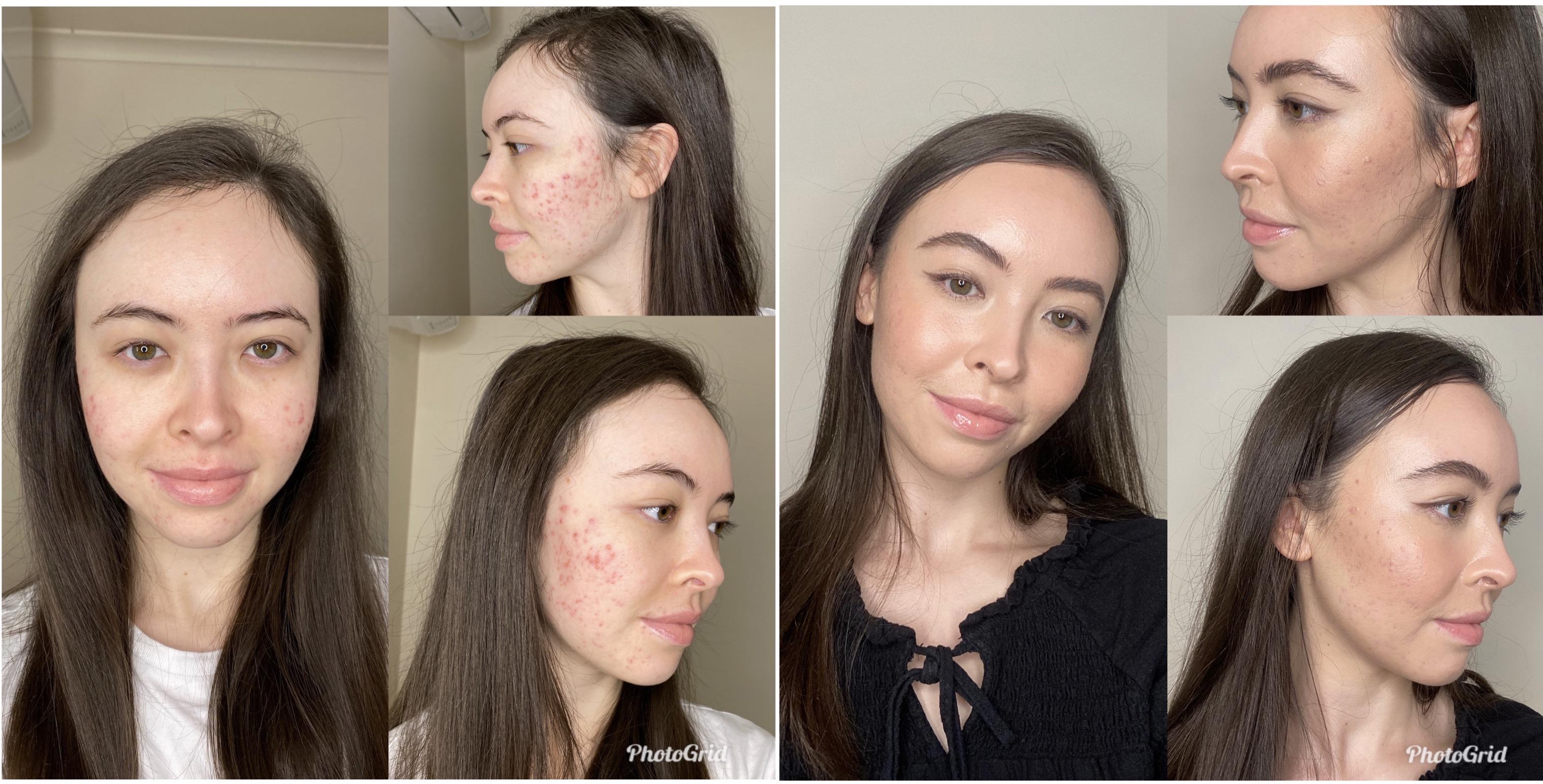 Natural and glowy makeup is impossible for AcneProne skin? I