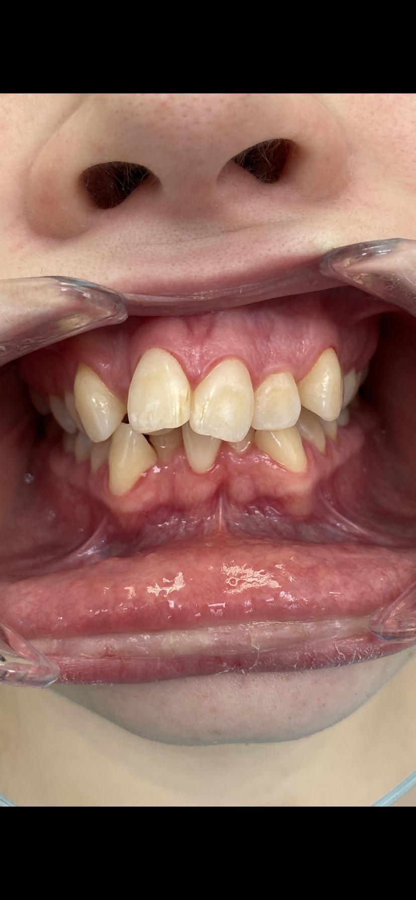 Braces off yday! Can't believe the difference and feel like a totally