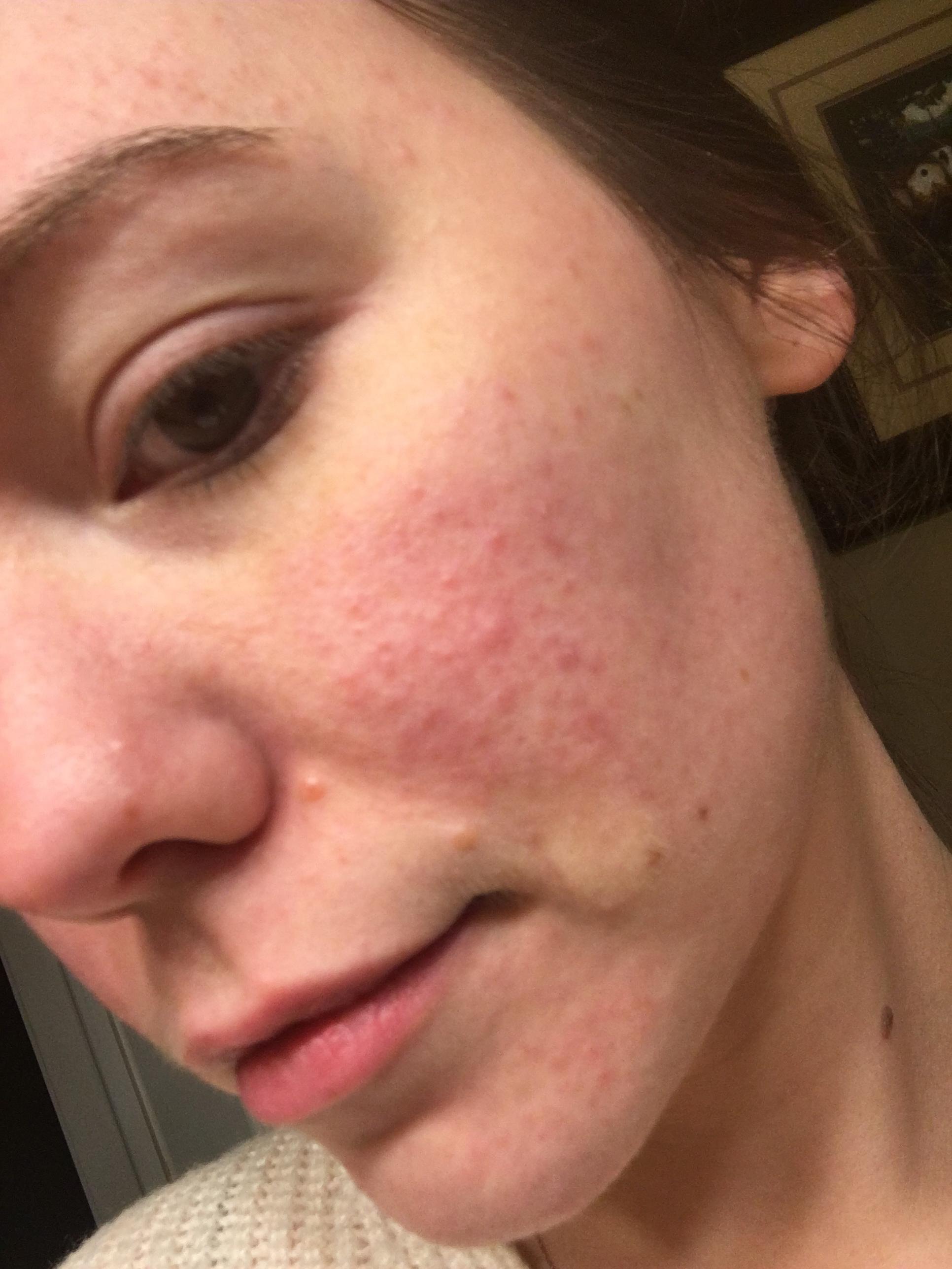 The bumps are driving me nuts. I don’t even know where to start to get