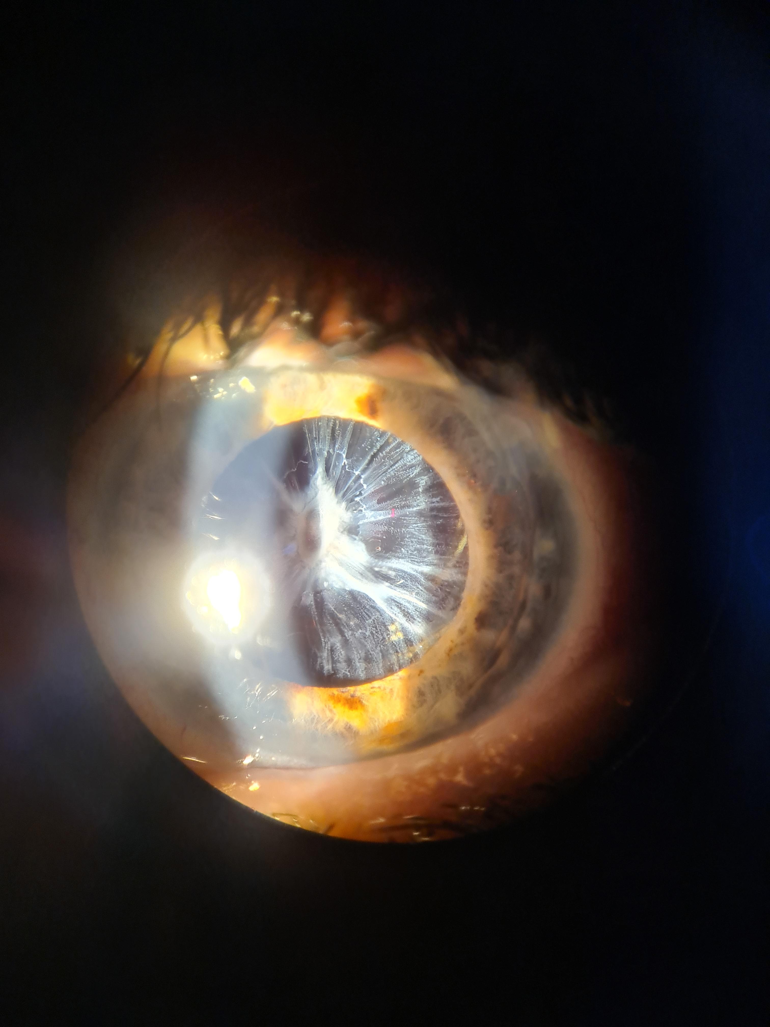 Severe anterior capsule phimosis r/Ophthalmology