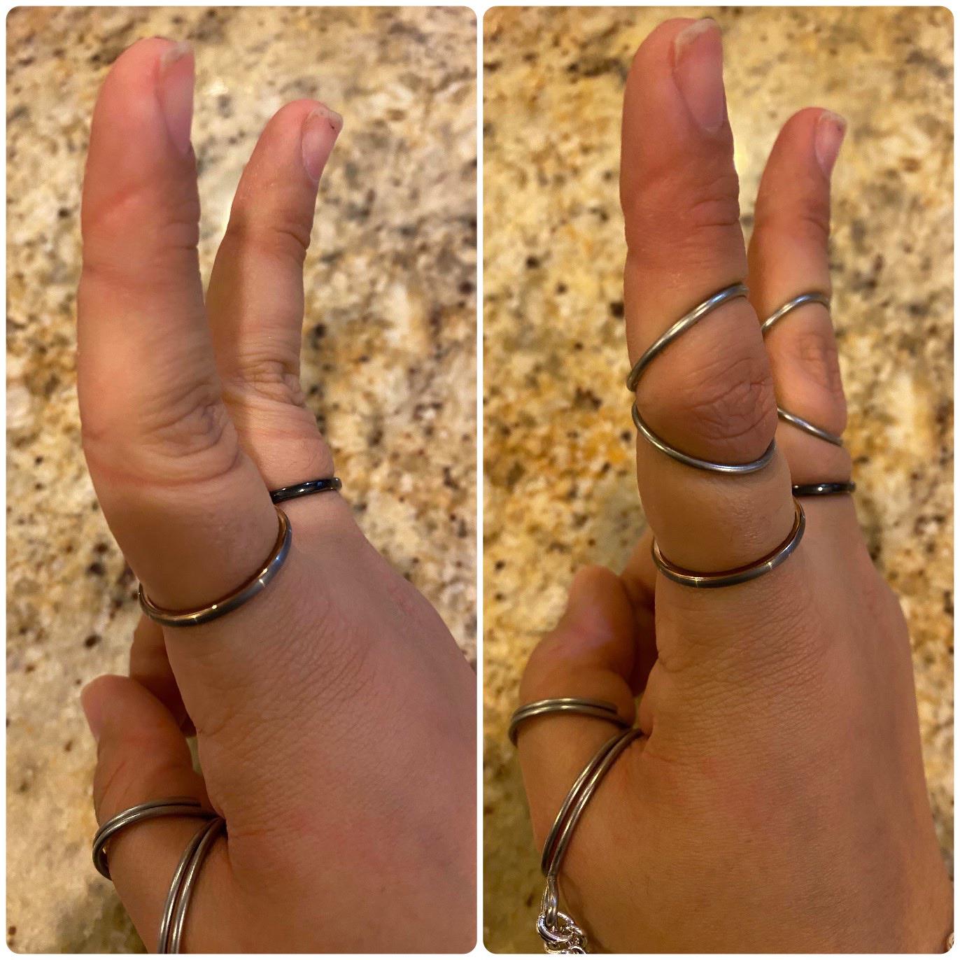 I make splints for fellow EDSers. I just got my latest customer photo