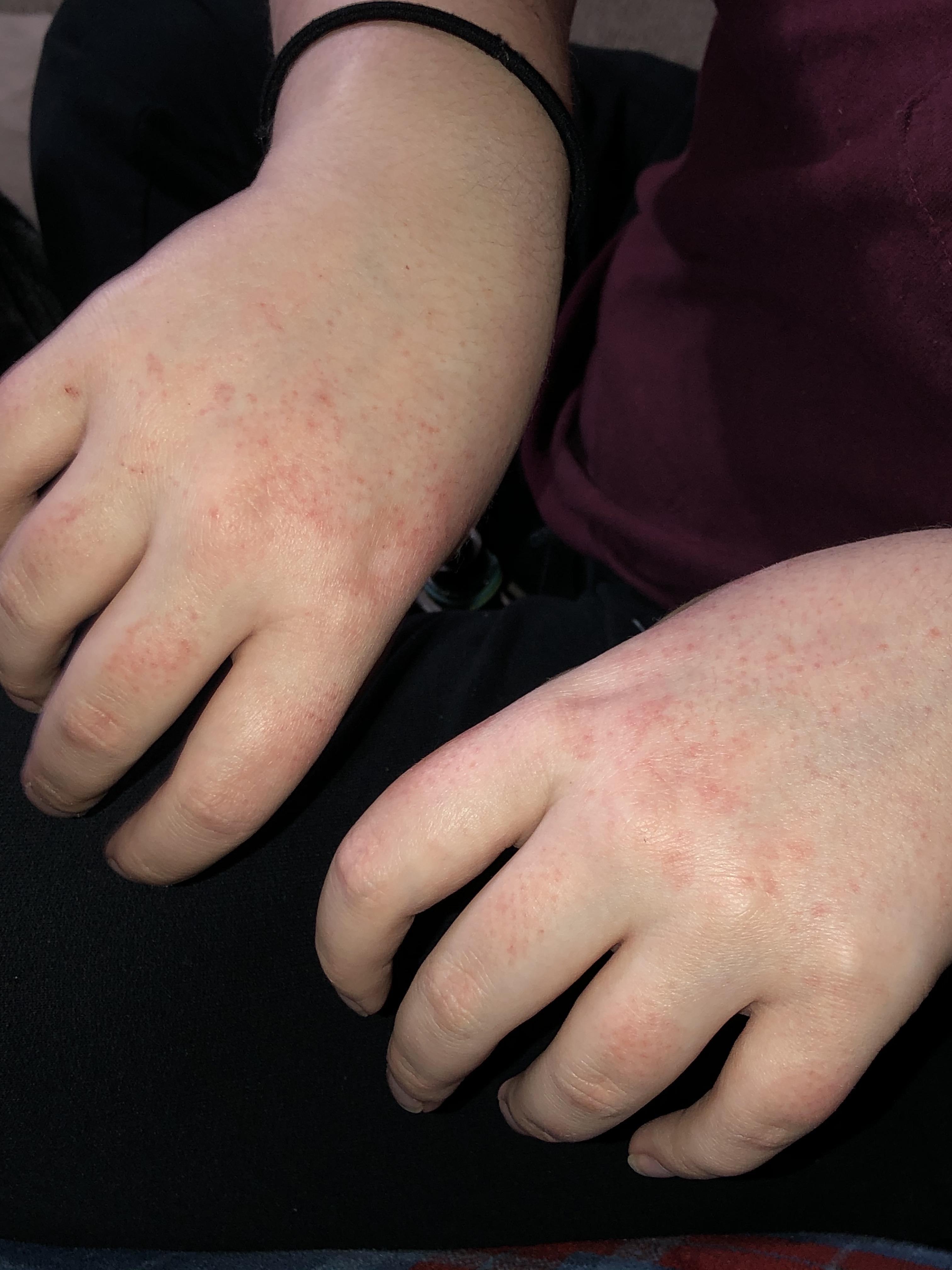 Rash on my hands?? Has this happened to anyone?? Been on Claravis 40mg