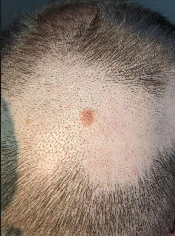 Diagnosed with Stage 1A Melanoma Today (Picture) Melanoma