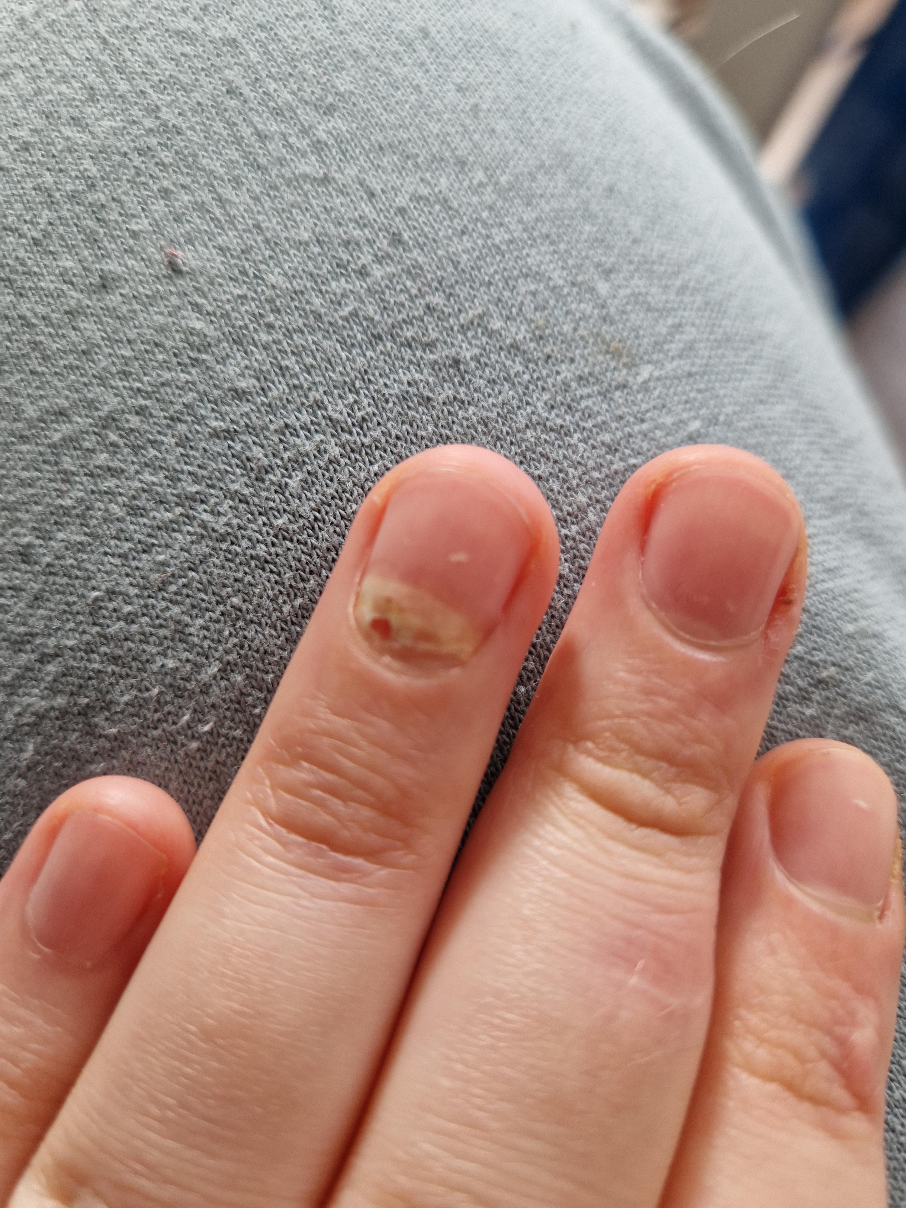 I have this weird spot/crack in my nail. I did not drop anything on it