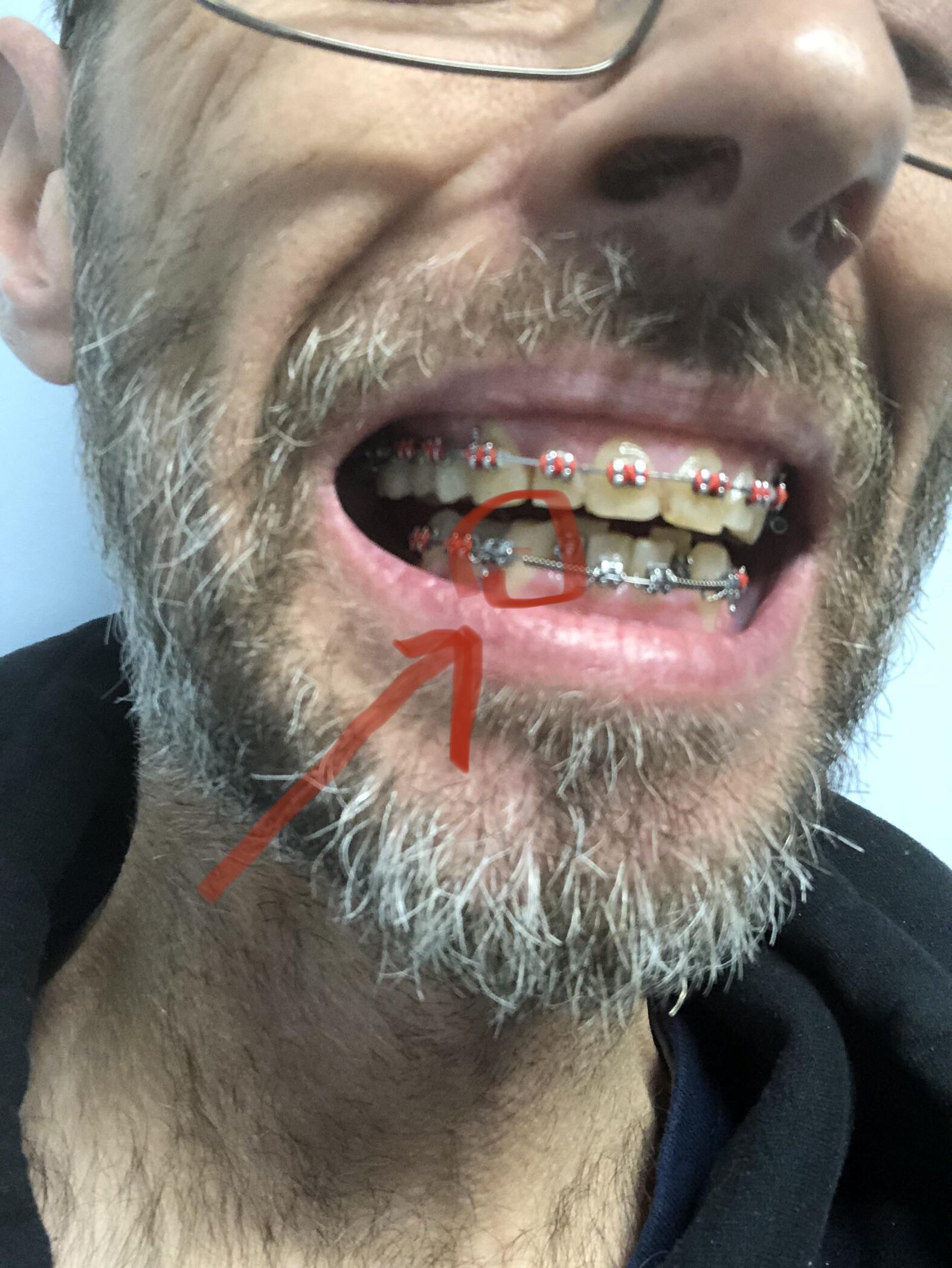 First picture , just got lowers . Broke a bracket r/braces