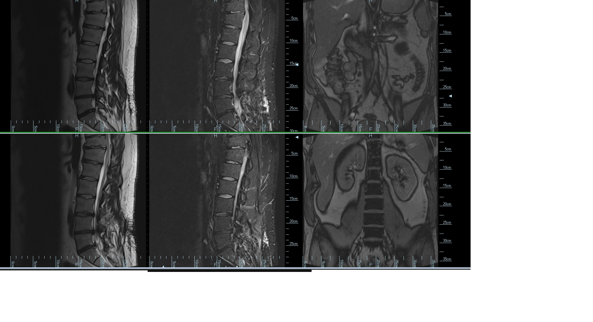 L Spine MRI r/Radiology