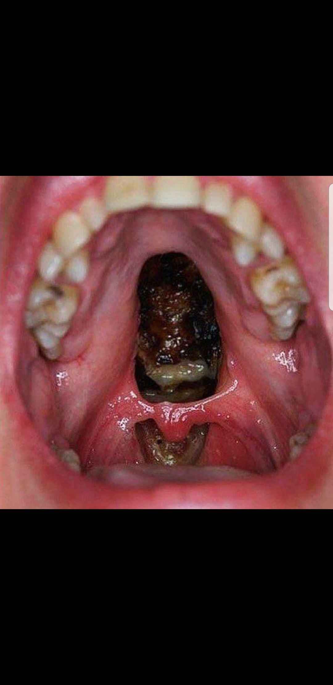 I saw this on reddit 50/50, apparently it's a coke users throat after