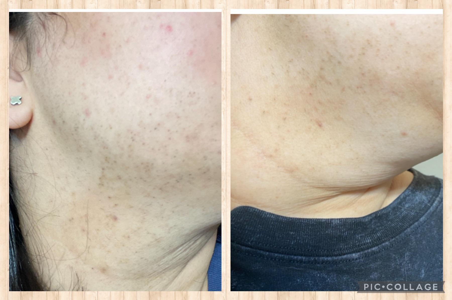 Spironolactone/ at home laser treatment progress r/Hirsutism