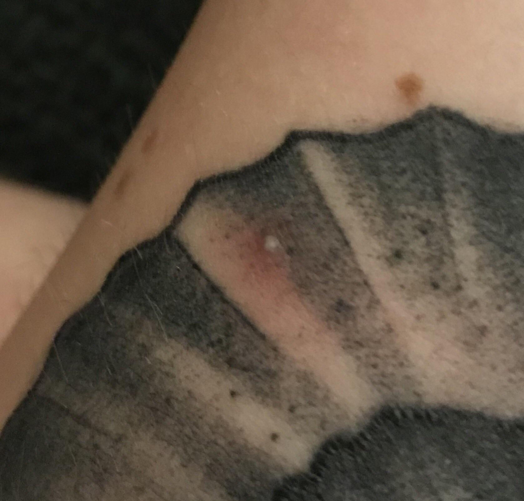 Ingrown hair under my new ink. Bummed that I can’t mess with it
