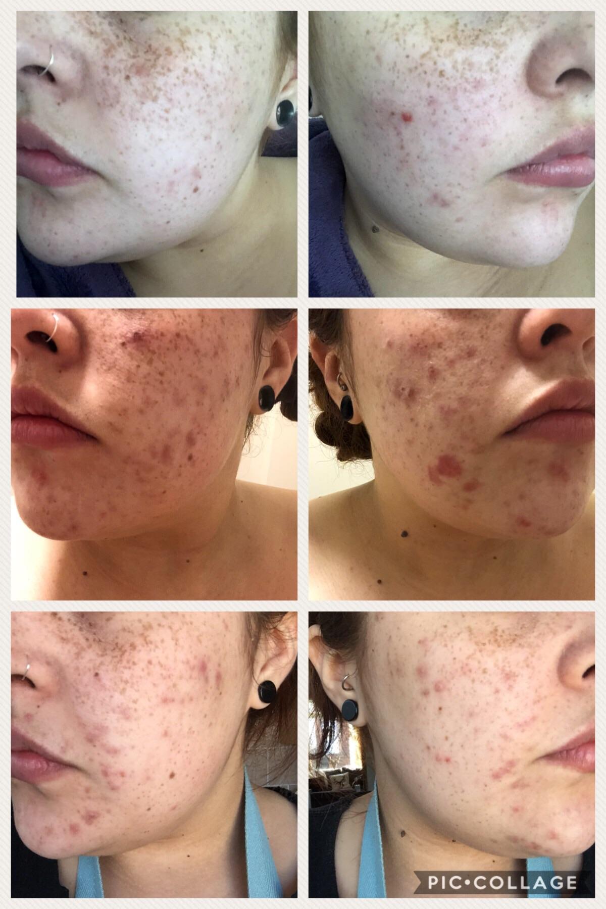 [B&A] 1 year progress with cystic acne r/SkincareAddiction