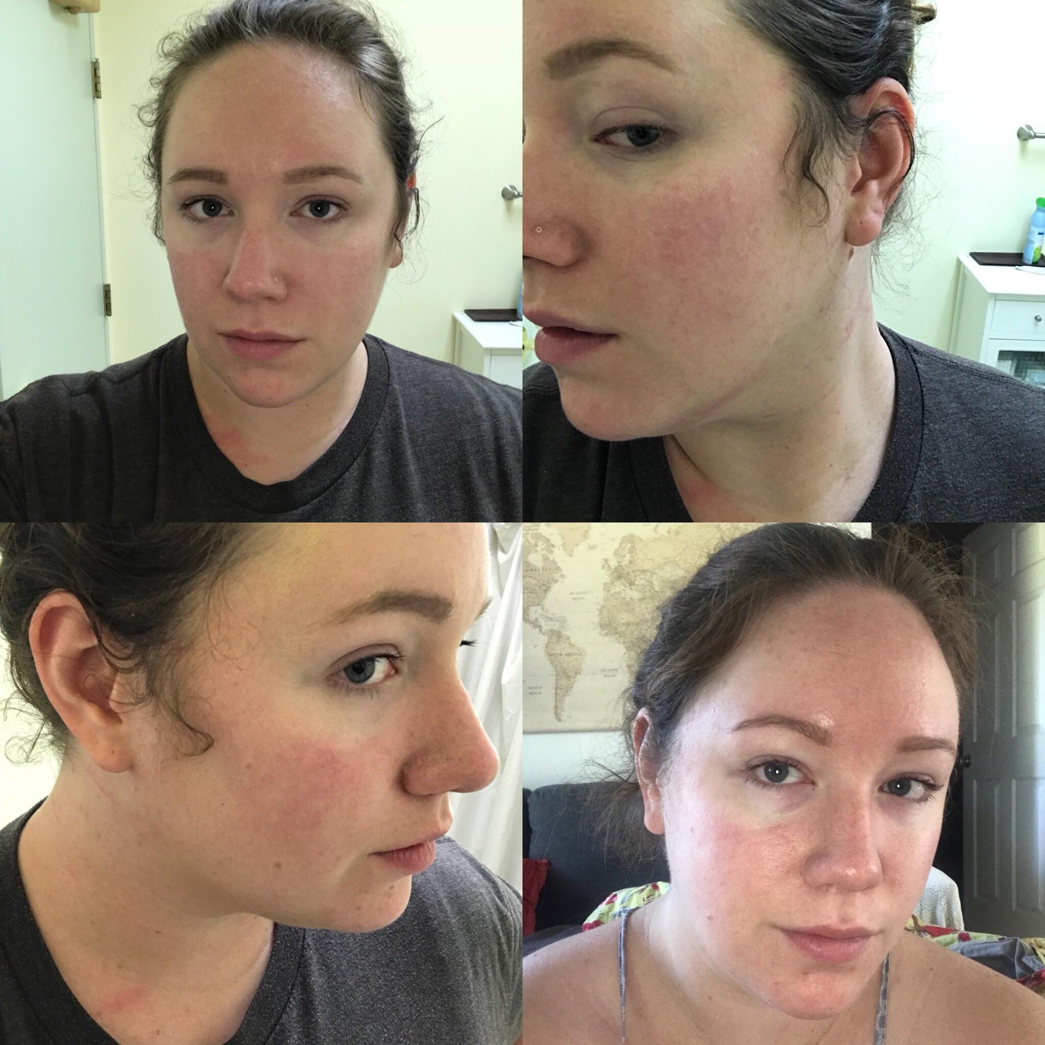 Need Advice for Triple Threat Skin Rosacea, Malar Rash, and