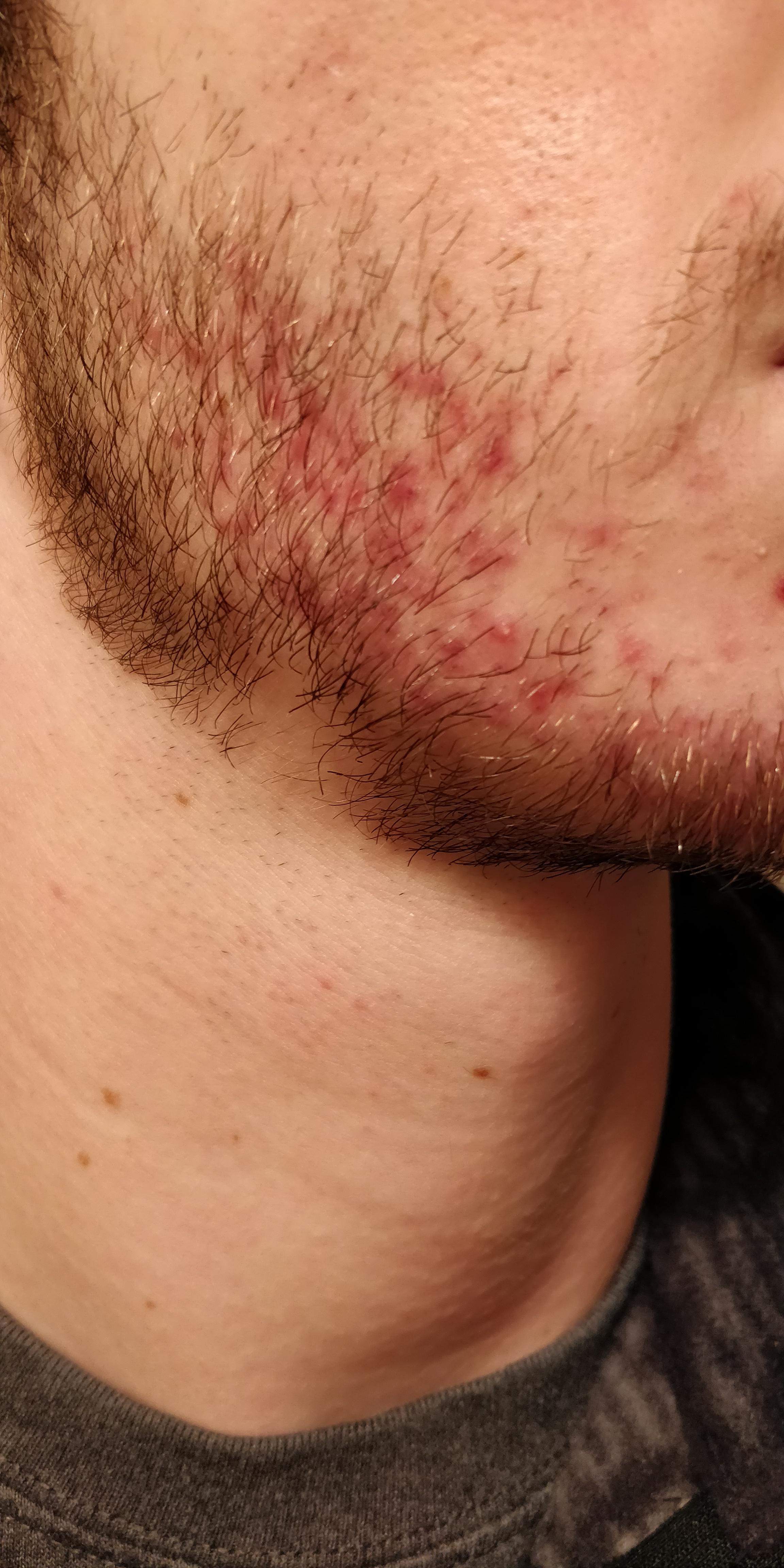 Help! What is this redness under my beard? I didnt use to have this