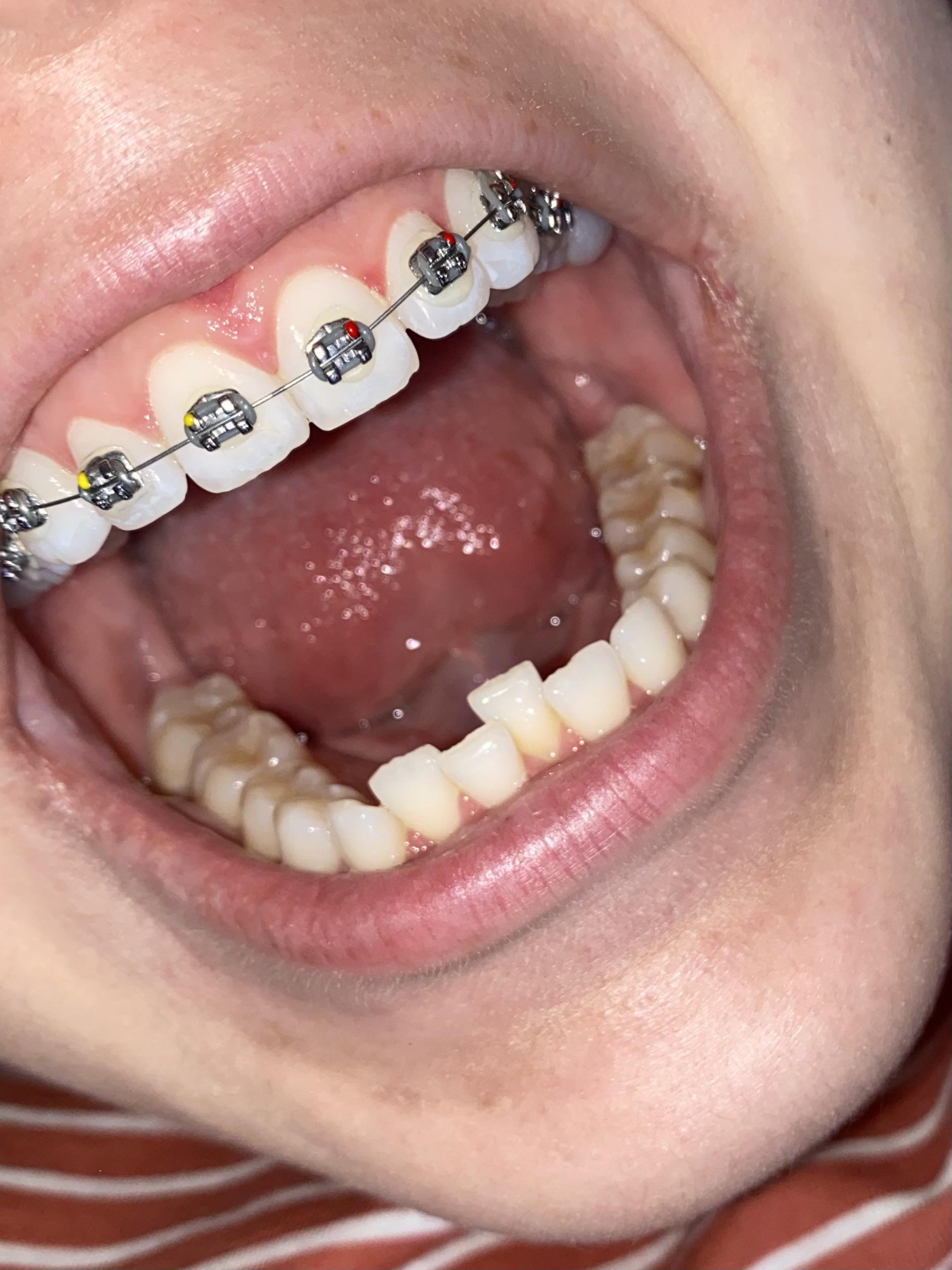 Um getting braces in Mexico, but has anyone else gotten just a row