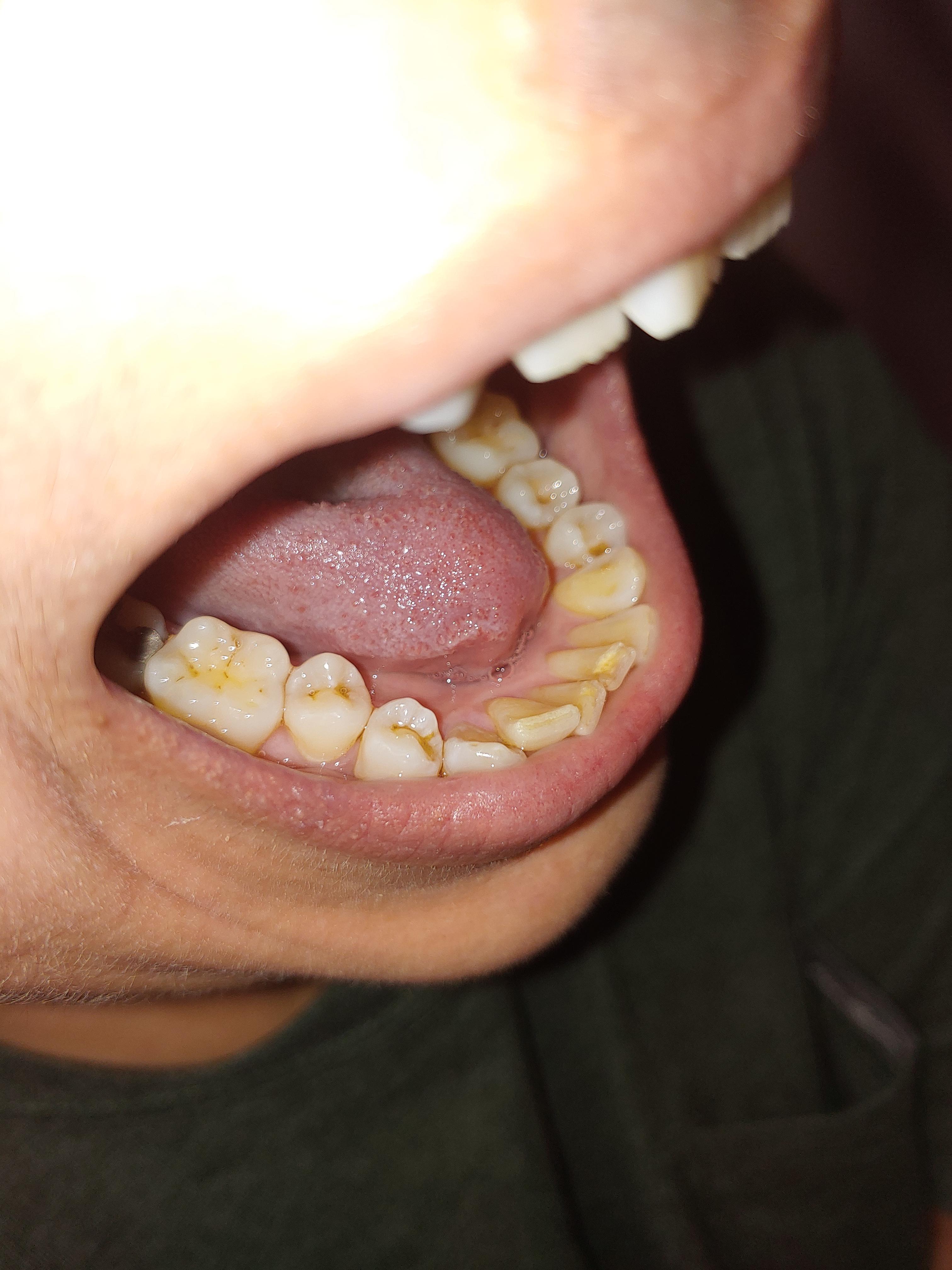 what are teeth supposed to look like after scale and root planning? r