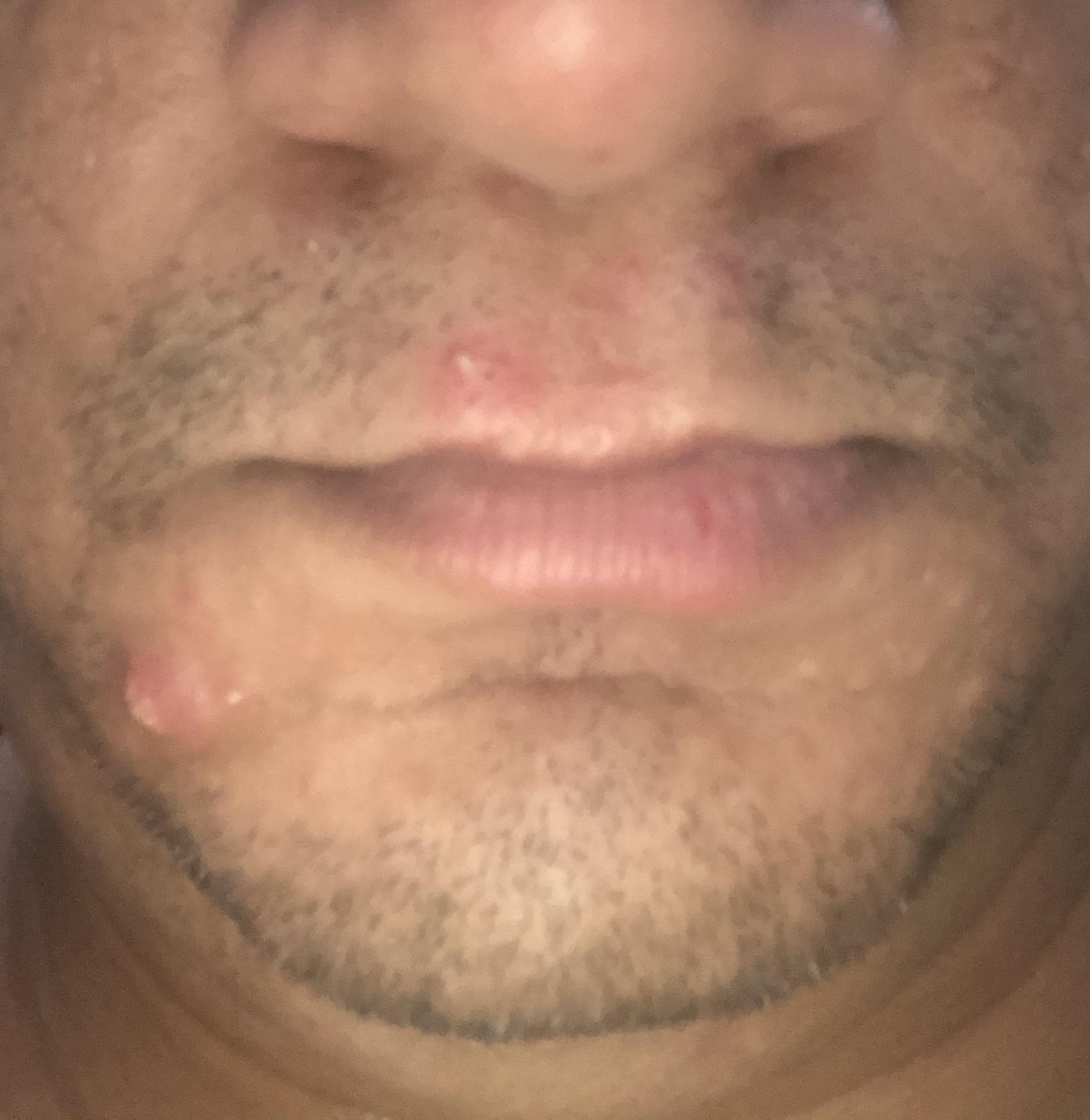 What and why do I keep getting these around my lips ? Only lips ? More often than not after