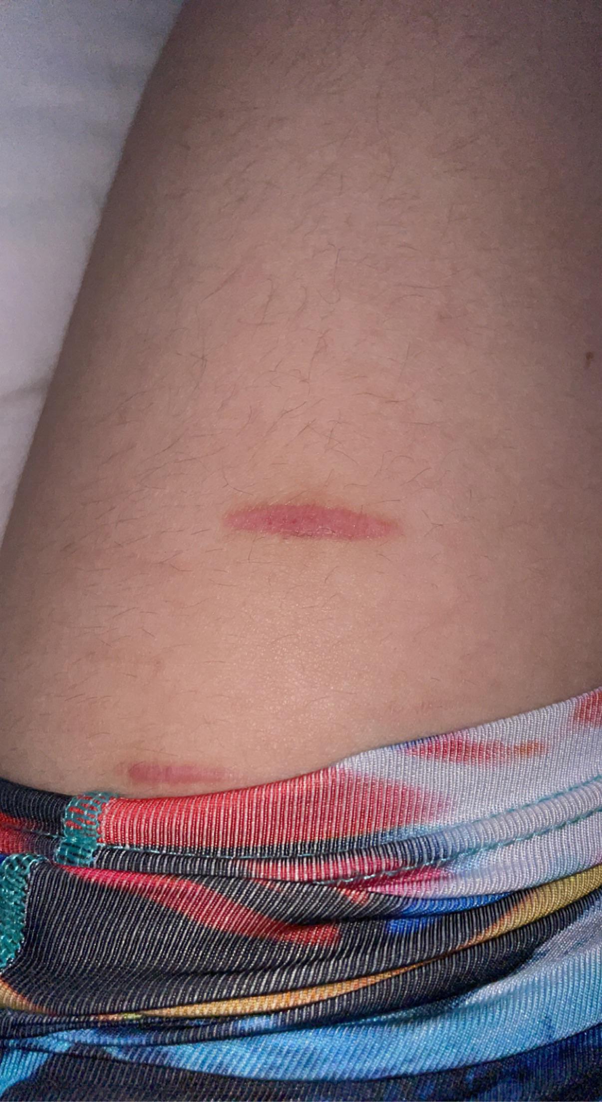 really small scar on my leg. it’s a little over a month old but it still itches/hurts from time