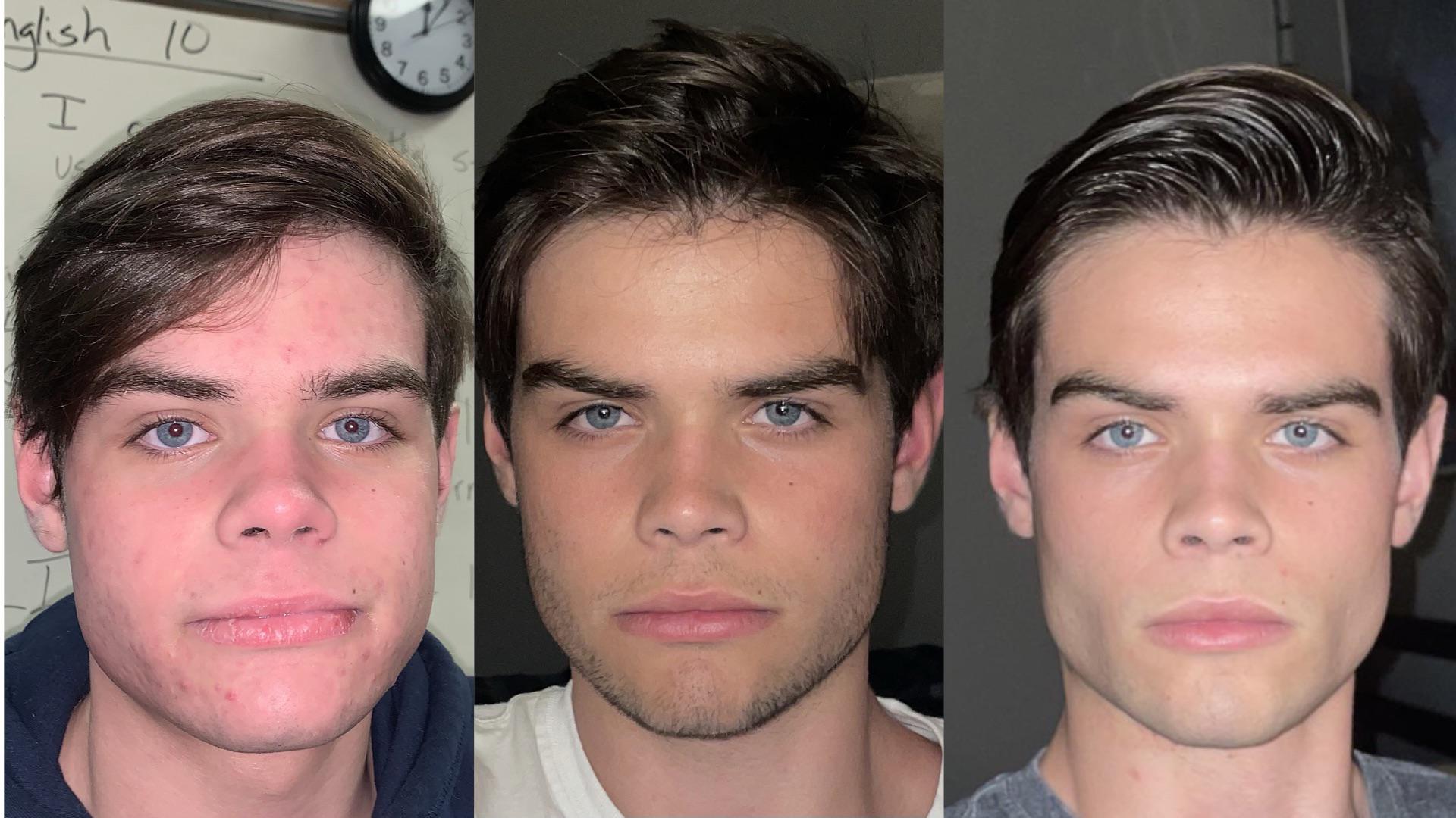 (17M) 1 Year and 10 Month Mewing (No Chewing) (Same Weight) r/Mewing