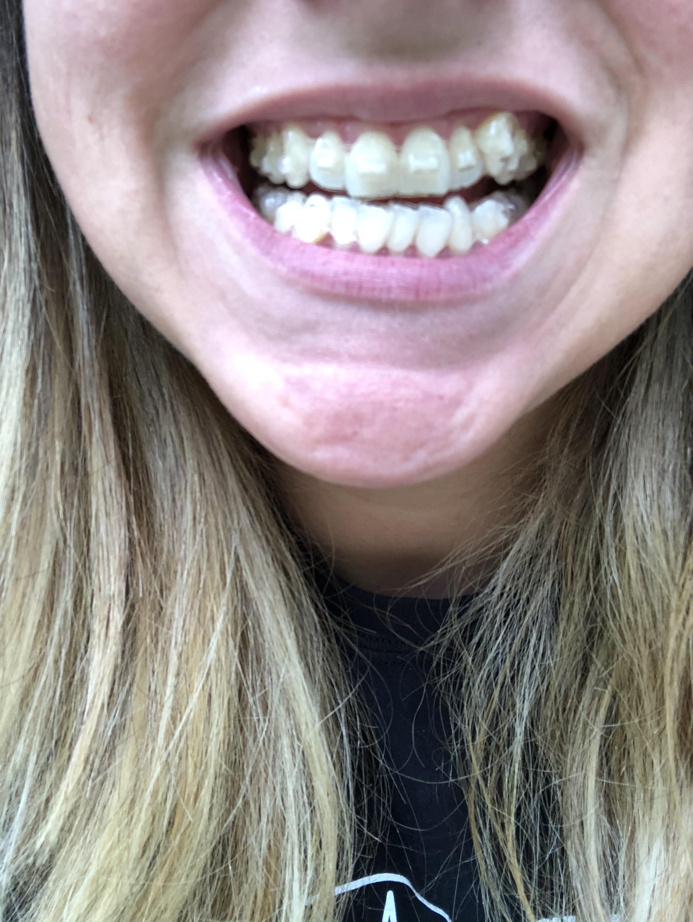 How long do you need to wear Invisalign® Clear Aligners?