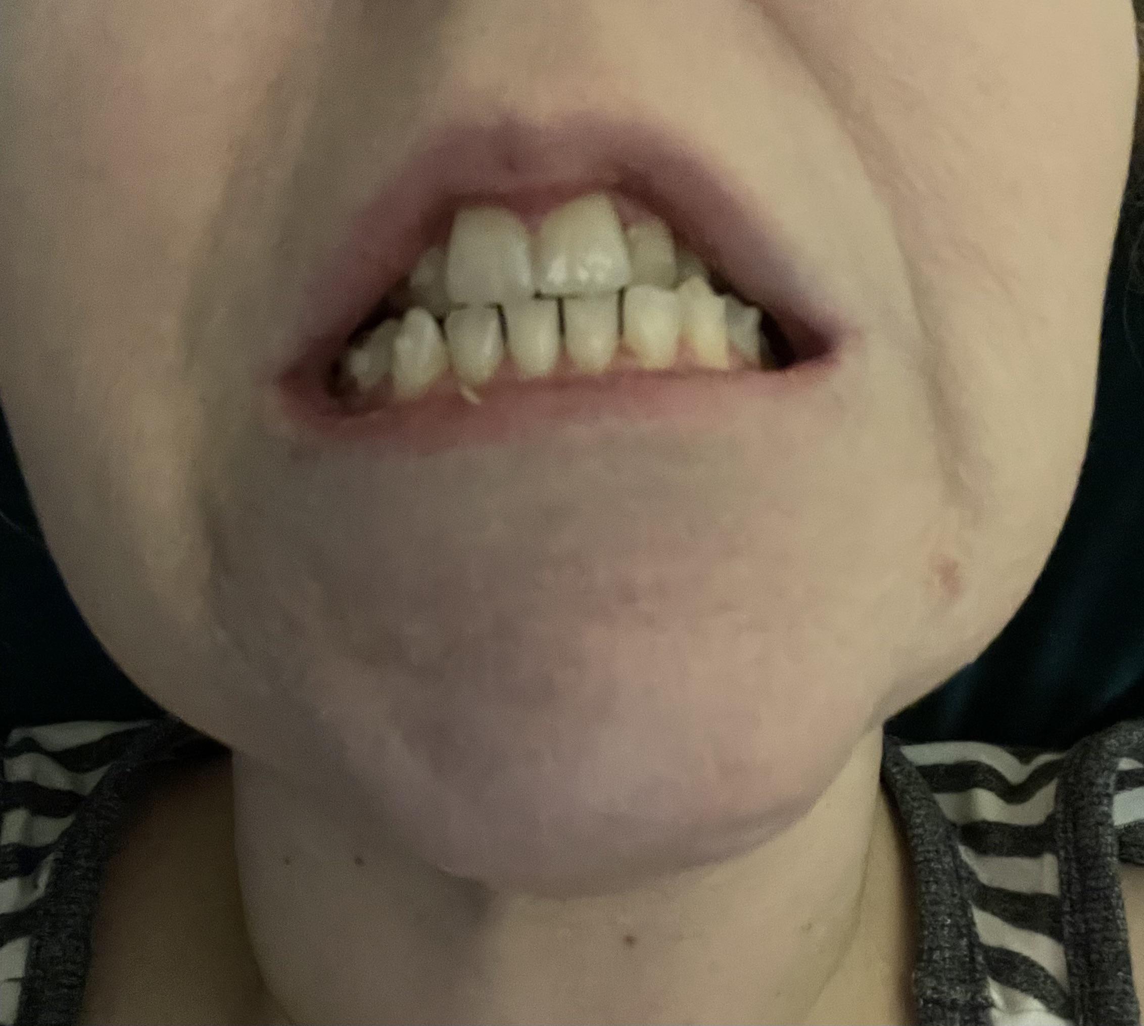 Did your orthodontist polish (shave) your teeth before tray 1 to allow