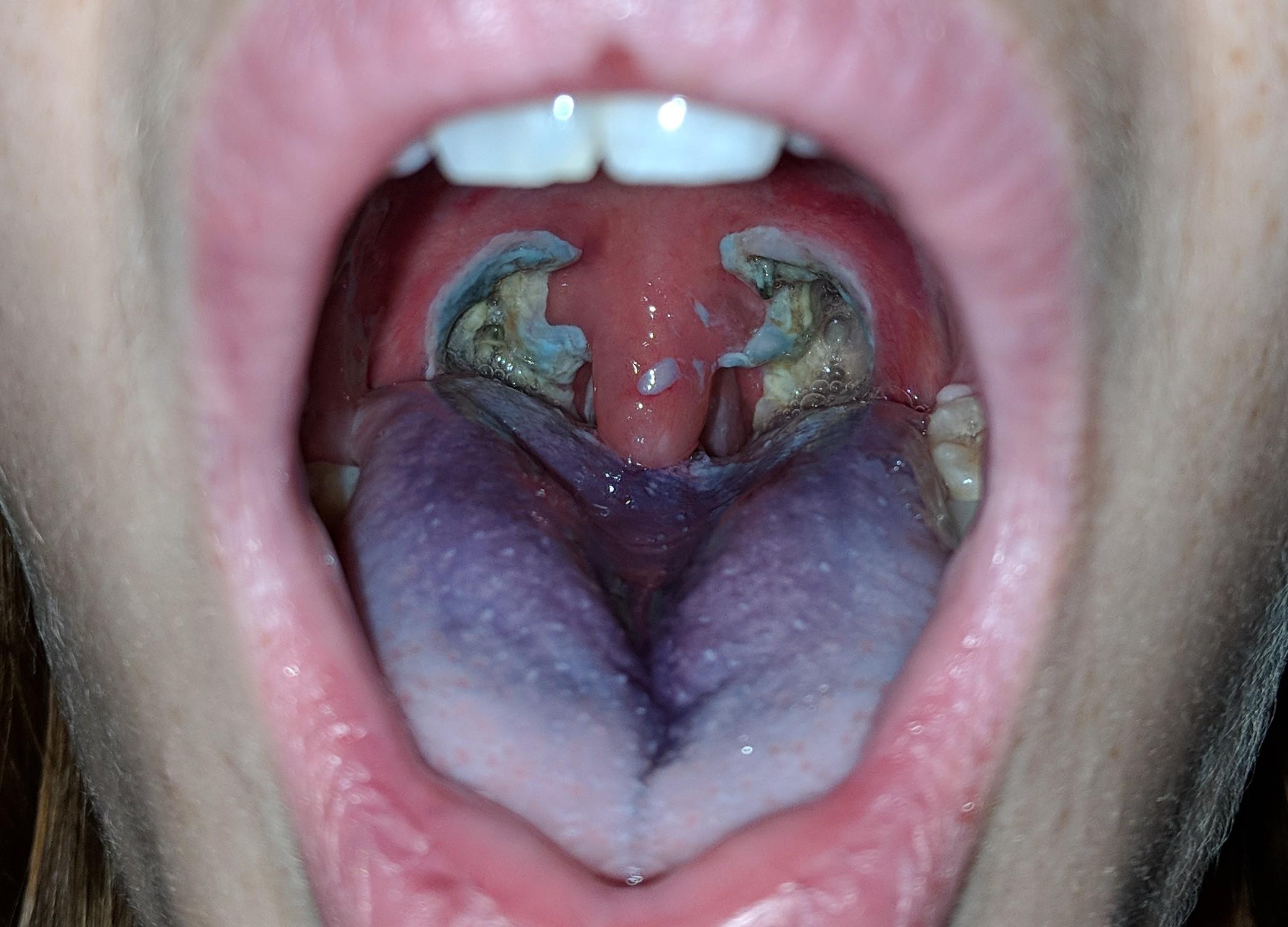 Day 3 after Tonsillectomy. Please excuse purple Gatorade